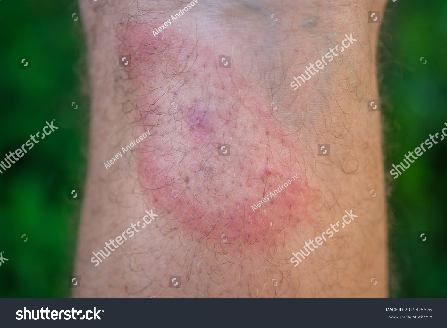 Migrating Erythema After Tick Bite On Foto Stok Shutterstock