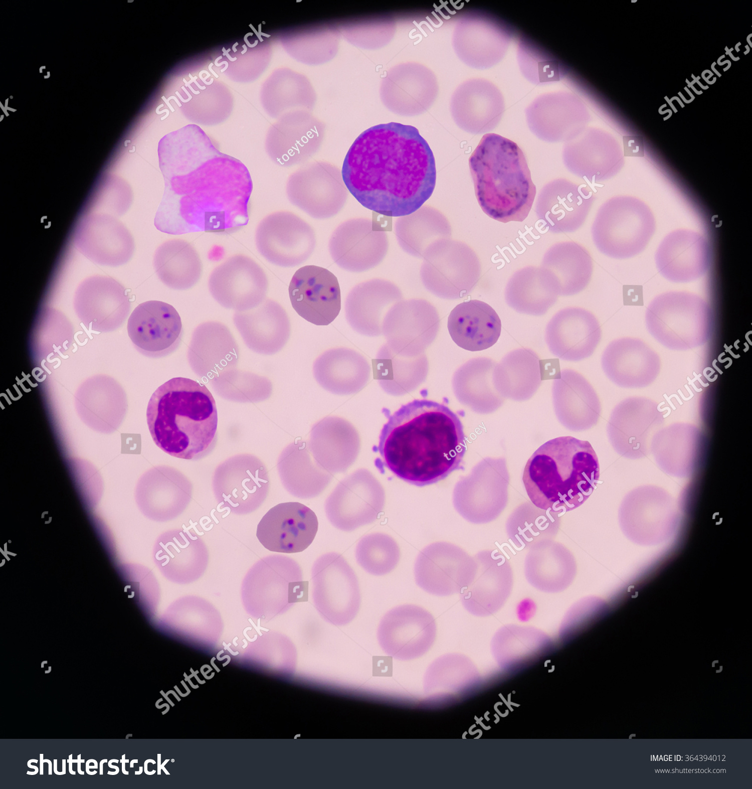 Mix Cellsmalaria Pigmentatypical Lymphocytemonocyteblood Smear Often