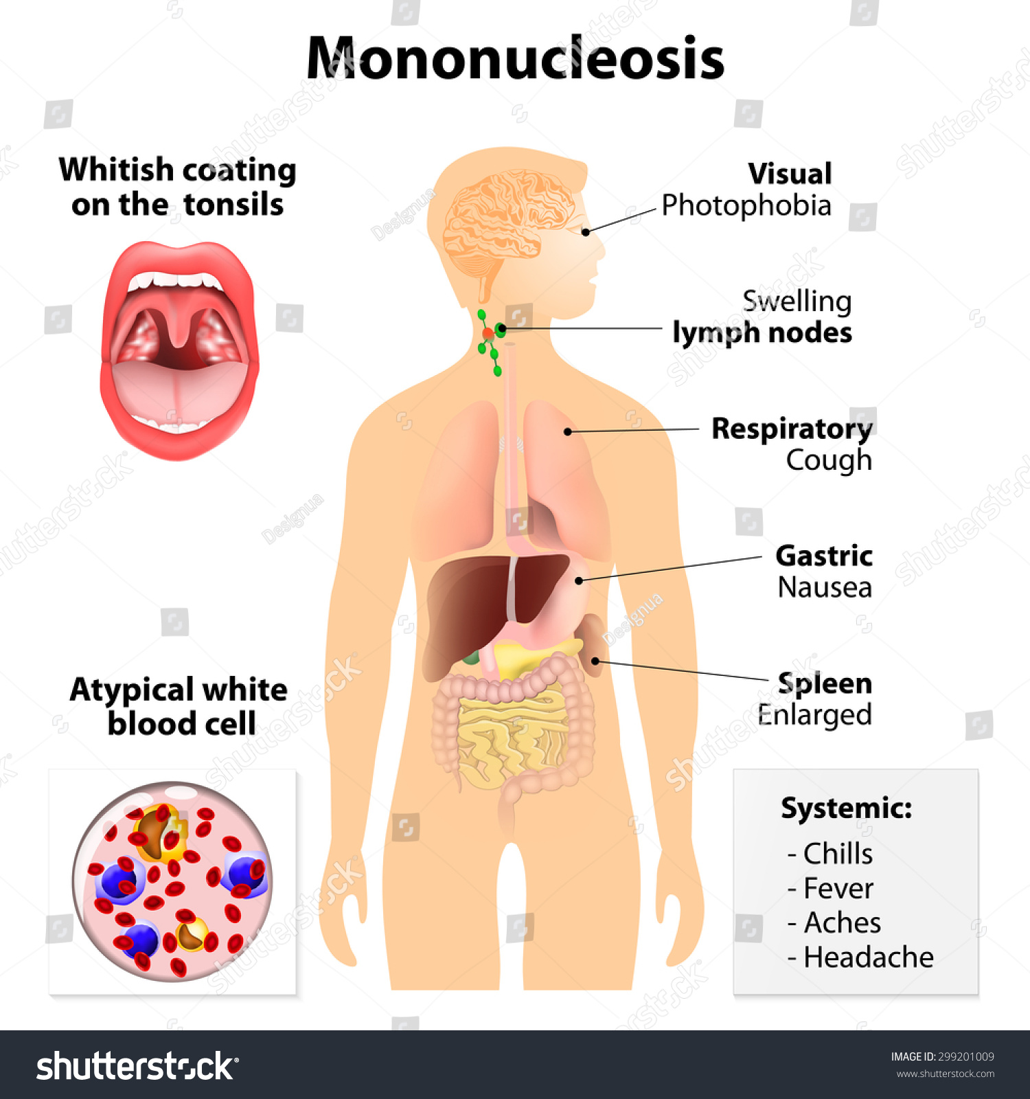 Infectious mononucleosis in adults Infectious mononucleosis in adults