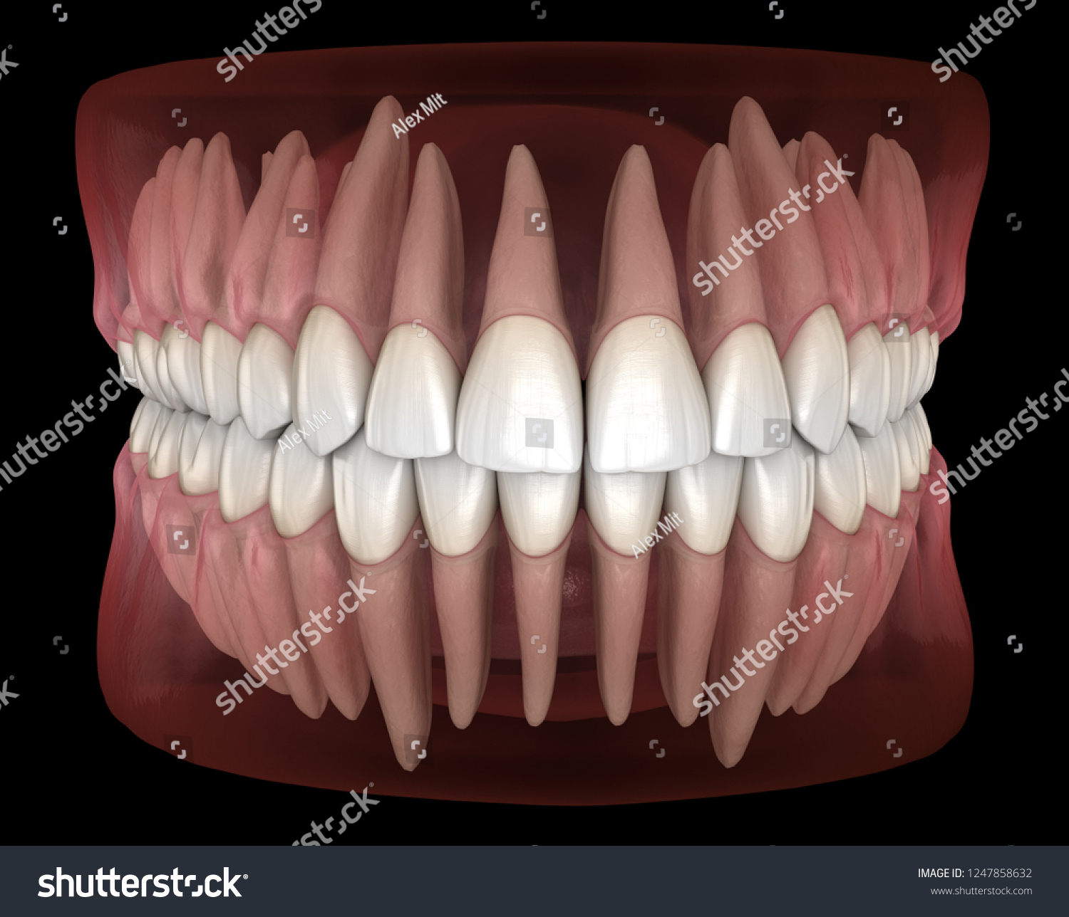 Morphology Mandibular Maxillary Human Gum Teeth H Nh Minh H A C S N