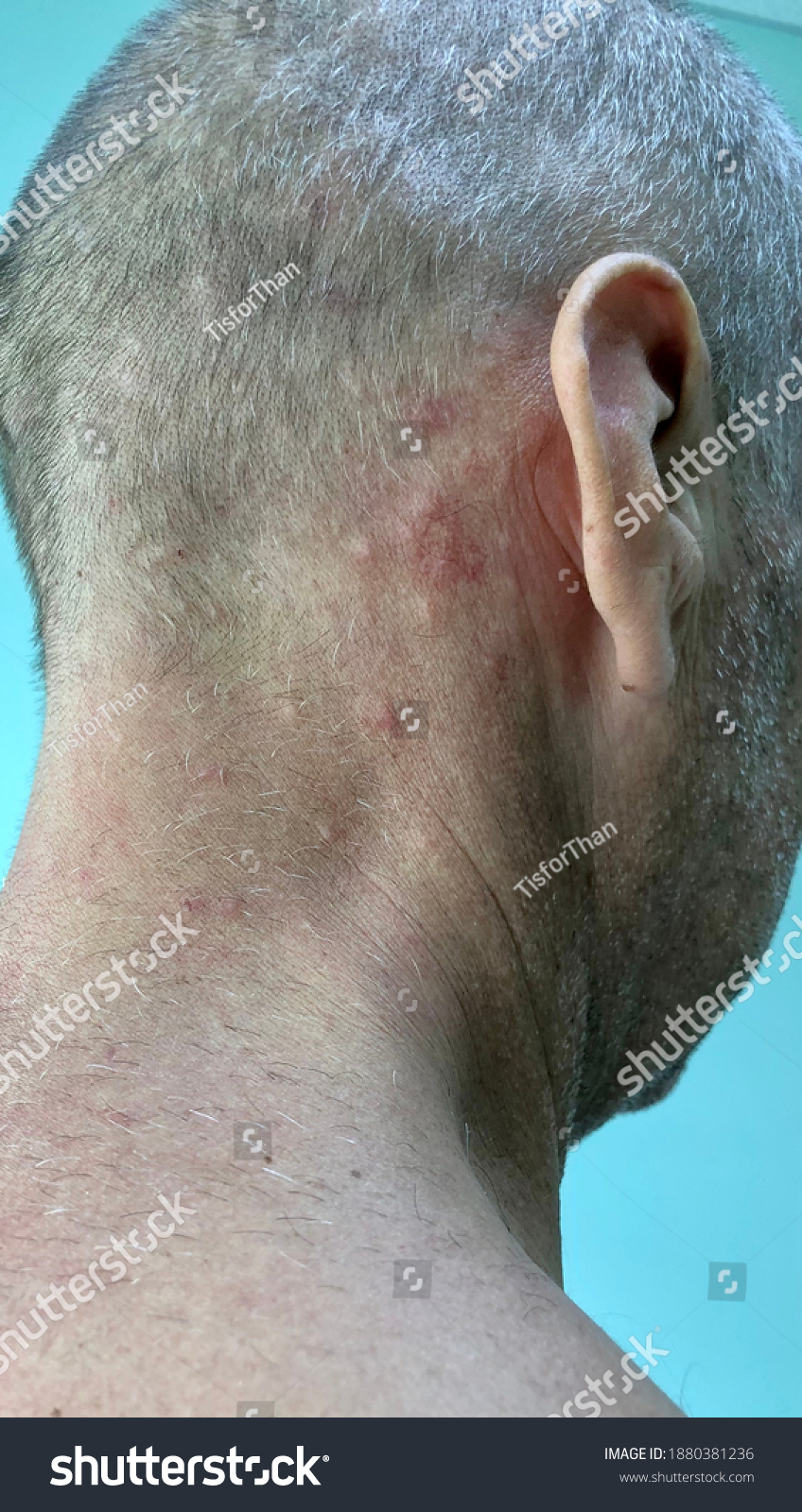 Multiple Illdefined Erythematous Itchy Rash Papule Stock Photo Edit