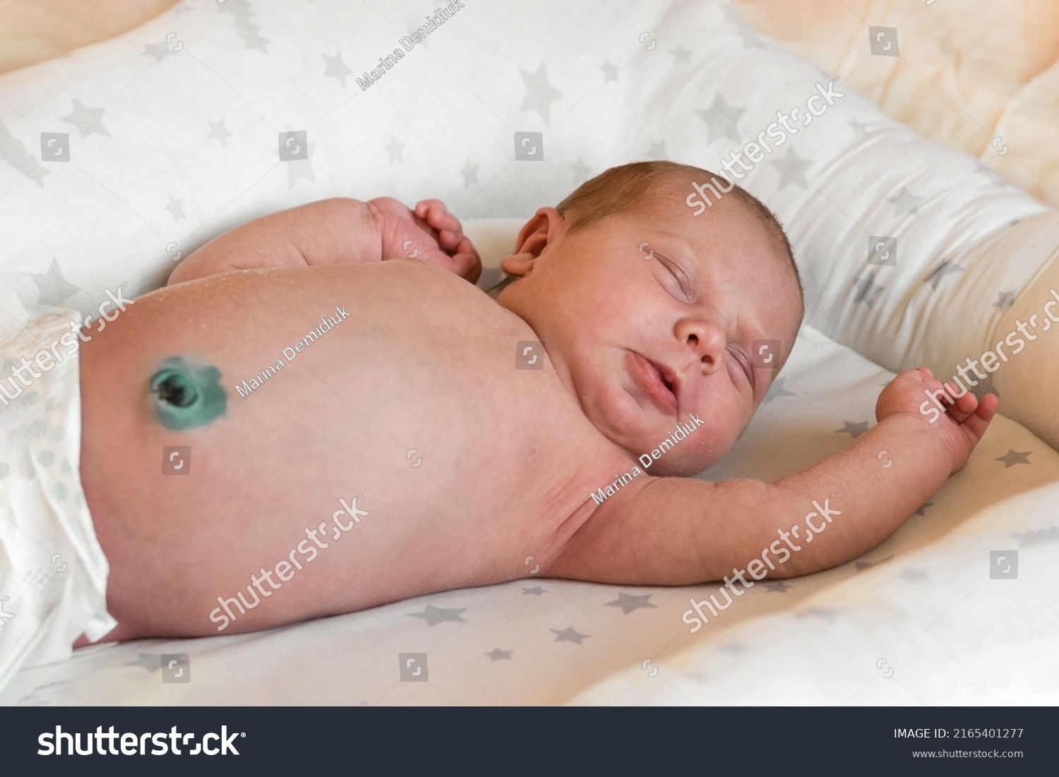 Naked Newborn Baby Unhealed Navel Treatment Stock Photo