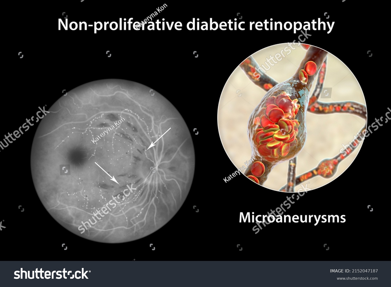 Nonproliferative Diabetic Retinopathy D Illustration Showing Stock