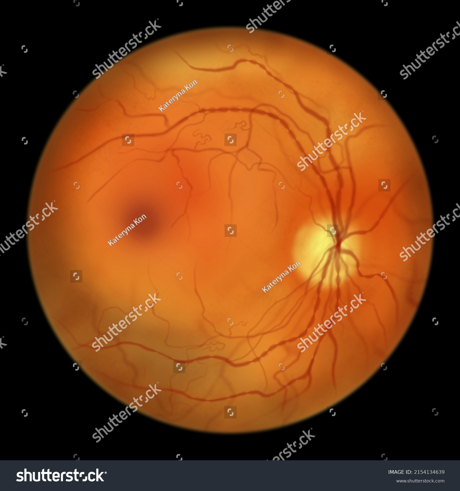 Nonproliferative Diabetic Retinopathy Illustration Showing Irmas Stock