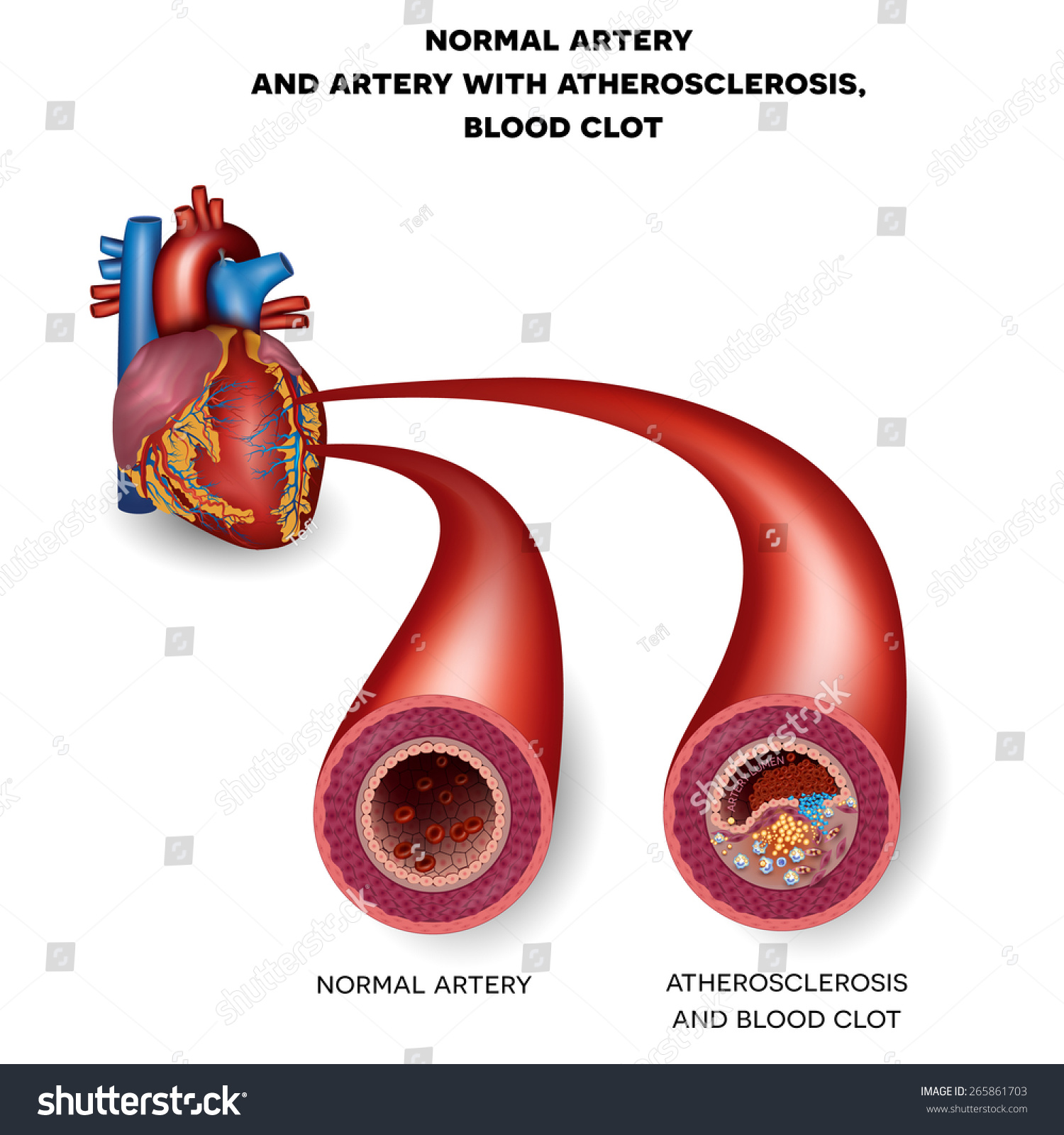 Normal Artery And Unhealthy Artery With Blood Clot Plaque Rupture