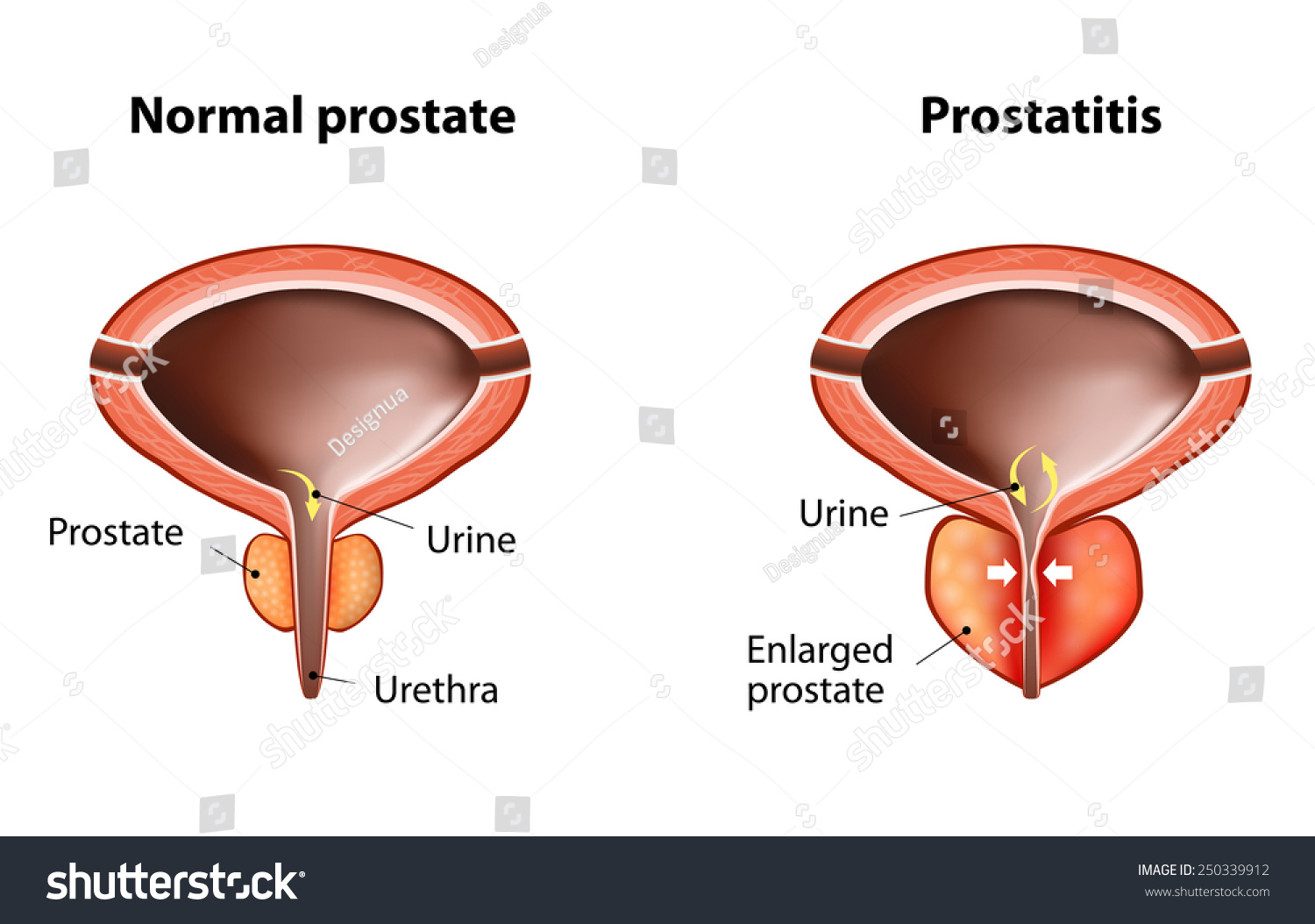 prostatitis az elmúlt szakaszokban
