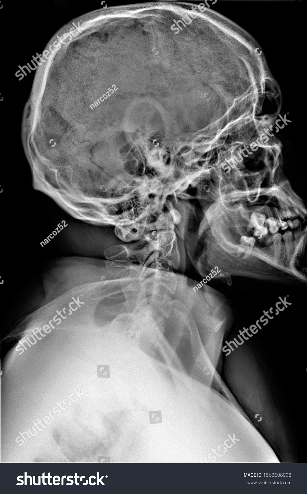 Normal Radiography Skull Lateral Projection Yellow Stock Photo Shutterstock