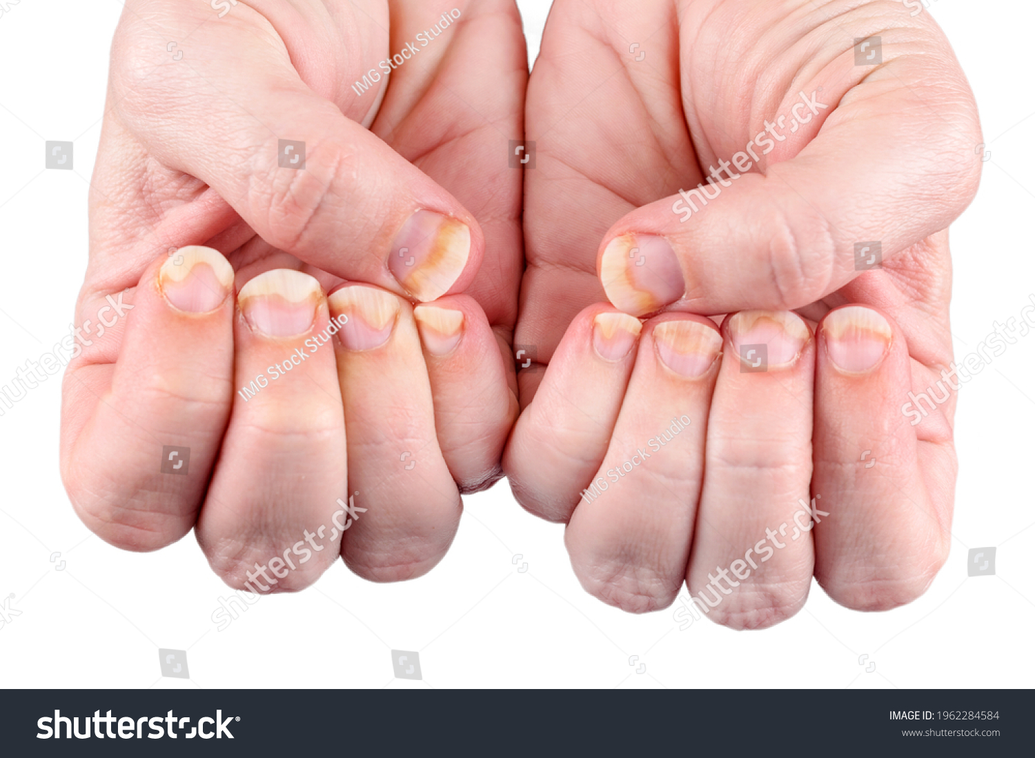 Onychomycosis Fungal Nail Infection On Damaged Stock Photo Edit Now