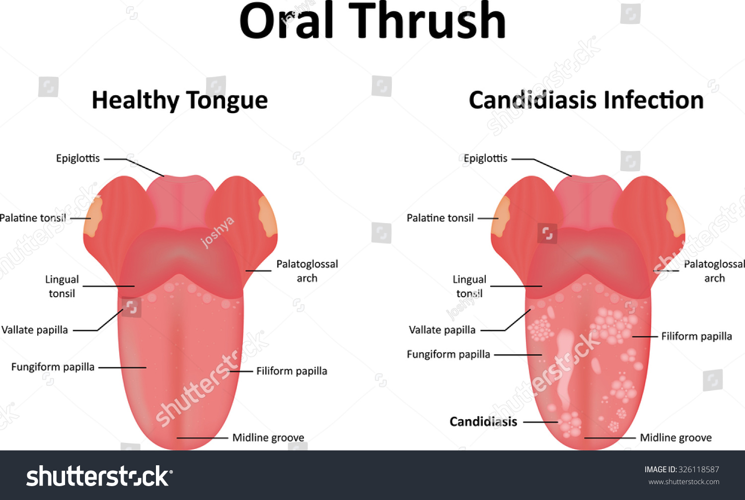 thrush-on-lips-symptoms-treatment-of-lip-fungus