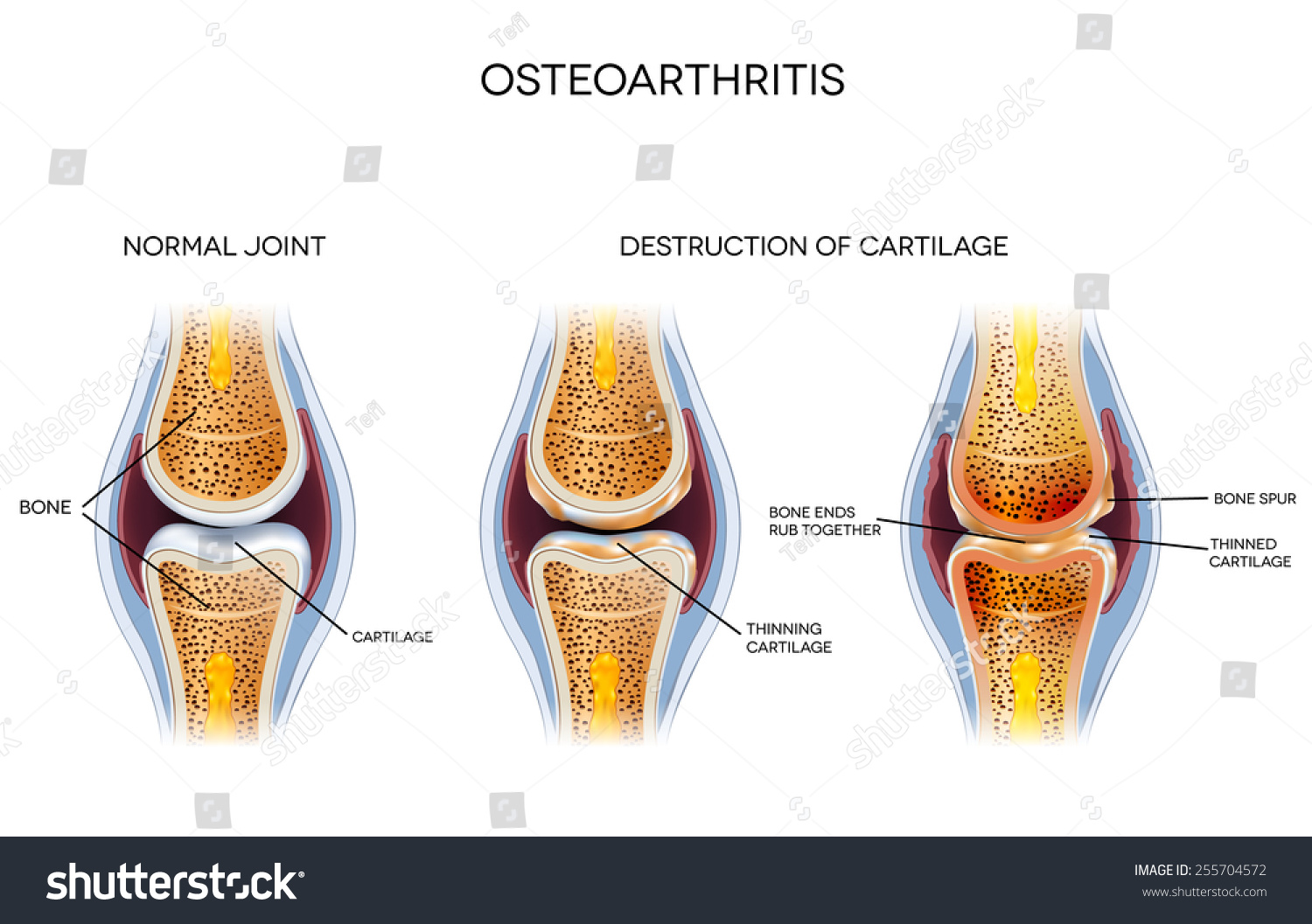 Osteoarthritis Destruction Cartilage Healthy Joint Unhealthy Stock