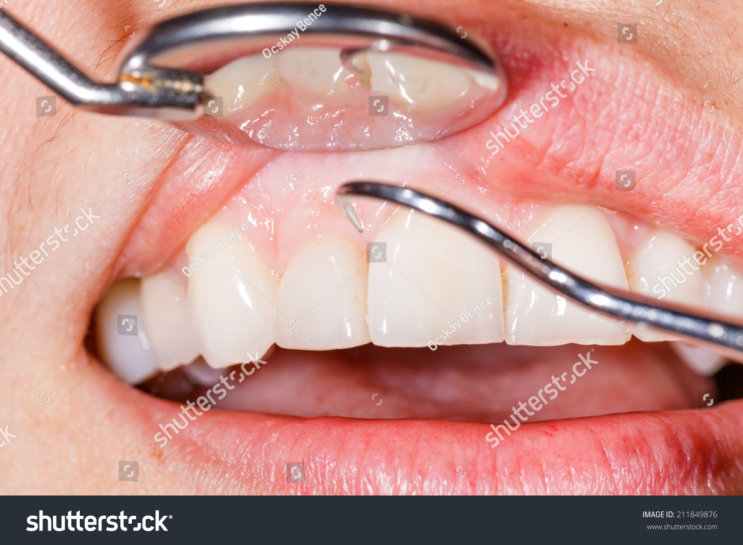 Periodic Dental Examination Have Healthy Mouth Stock Photo 211849876 ...