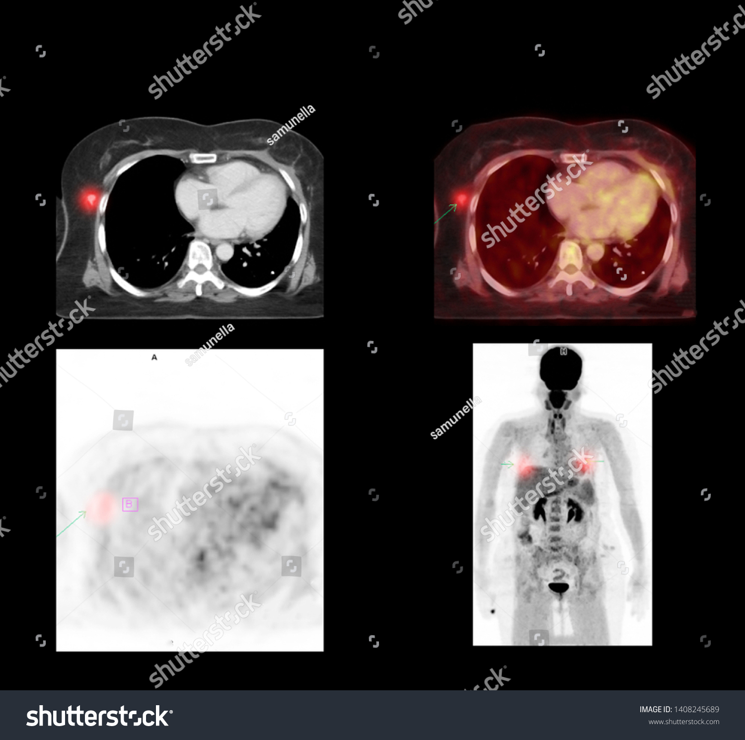 Pet Ct Scan Image Whole Body Ilustraci N De Stock