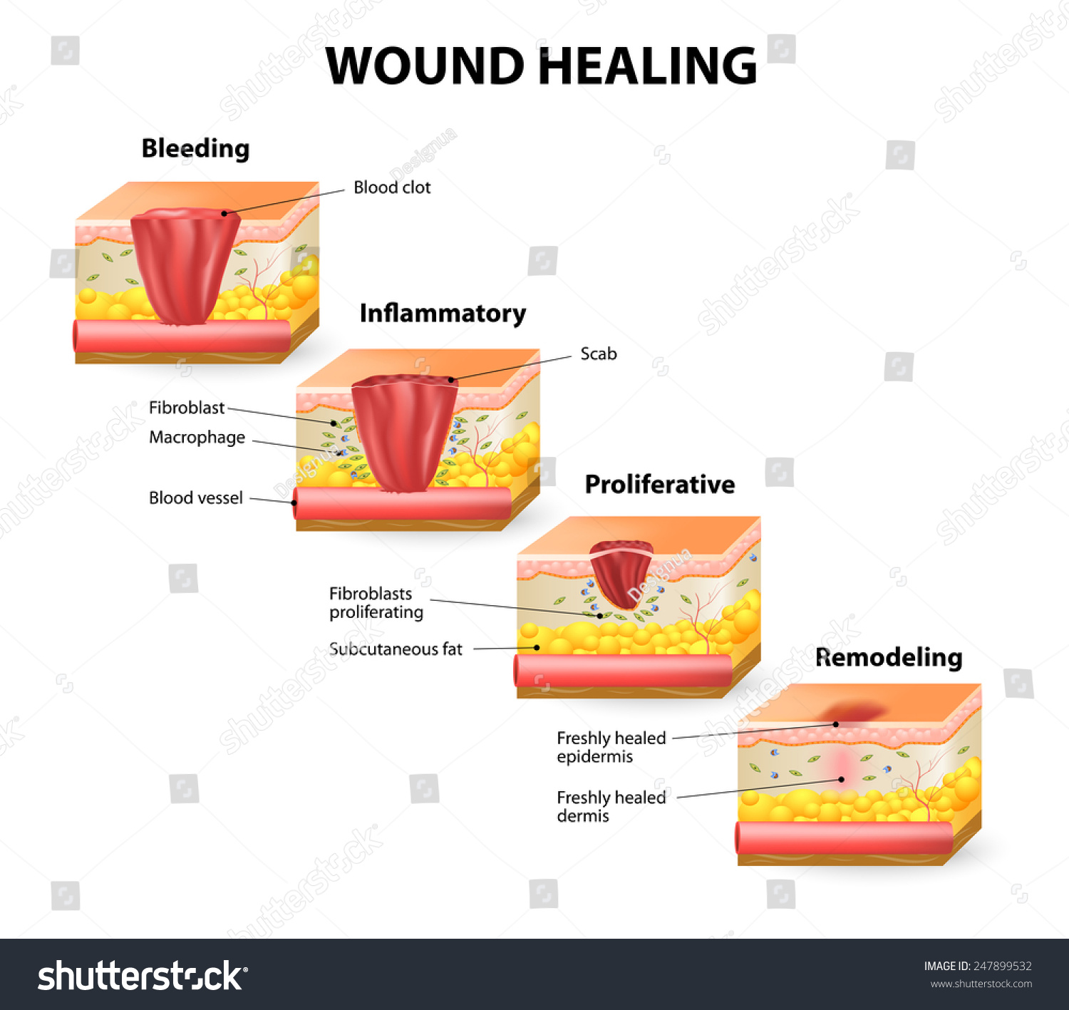 Phases Of The Wound Healing Process. Hemostasis, Inflammatory ...