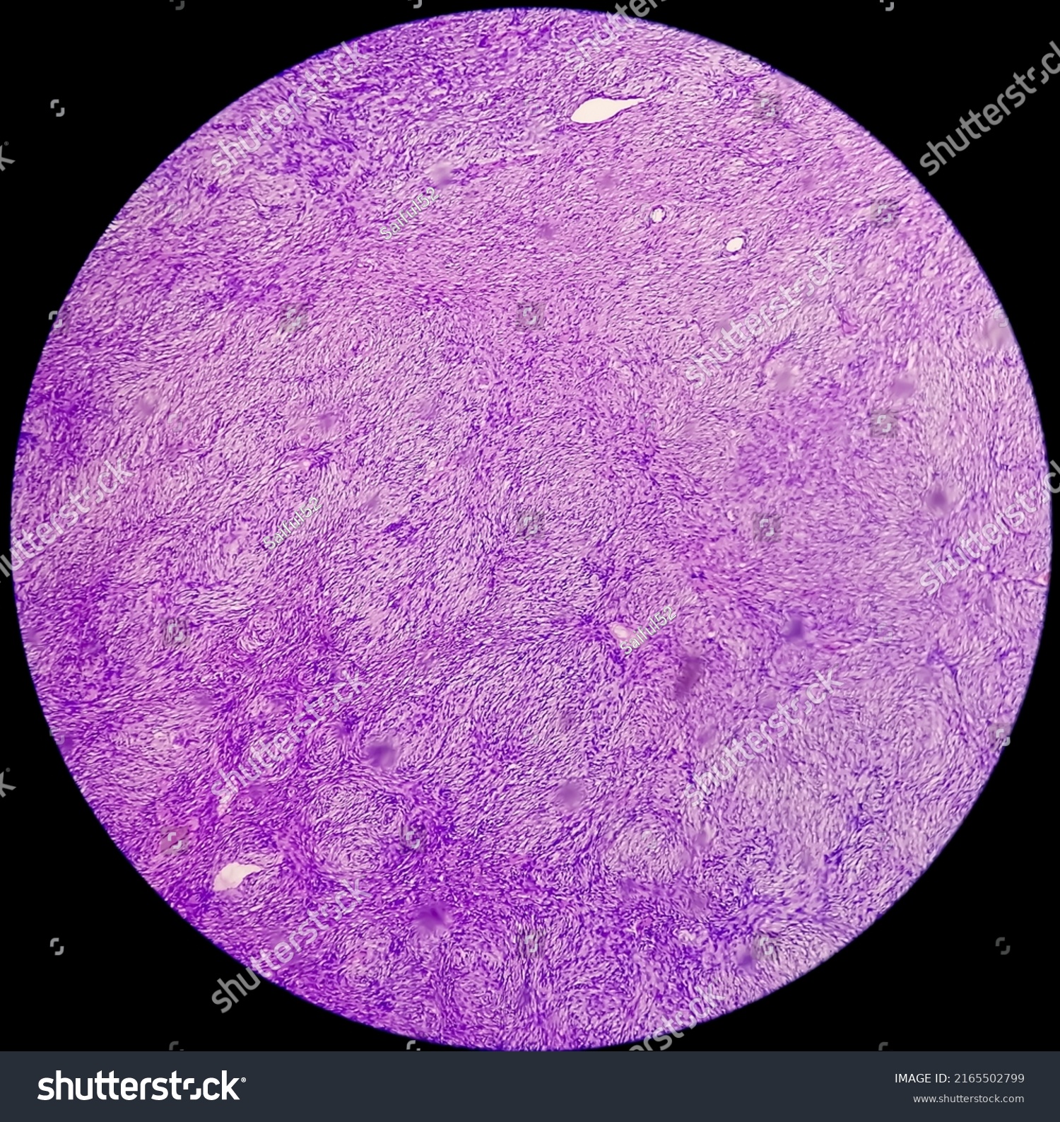 Photomicrograph Schwannoma Benign Soft Tissue Tumor Stock Photo