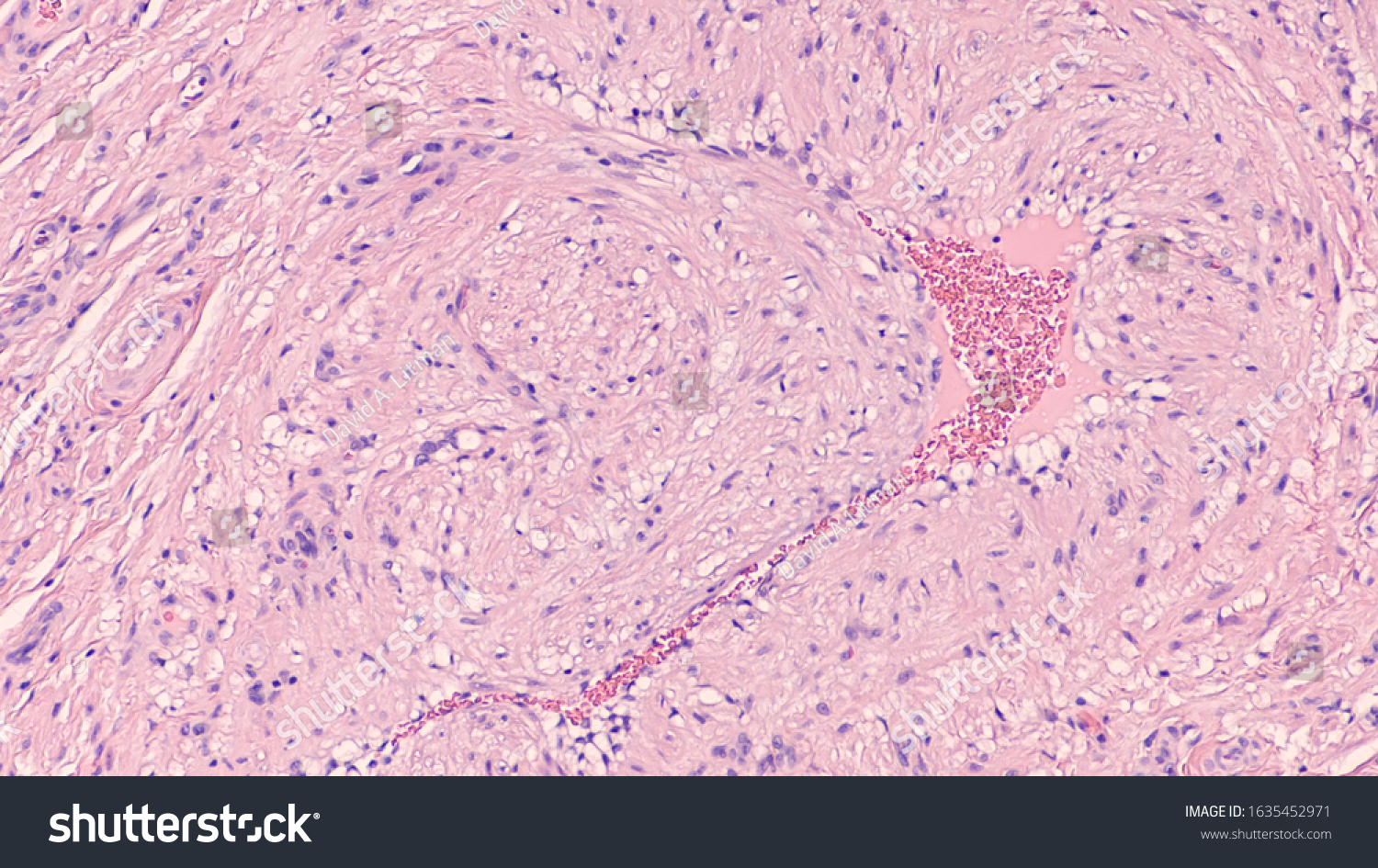 Photomicrograph Angioleiomyoma Type Leiomyoma Benign Tumor Stock Photo