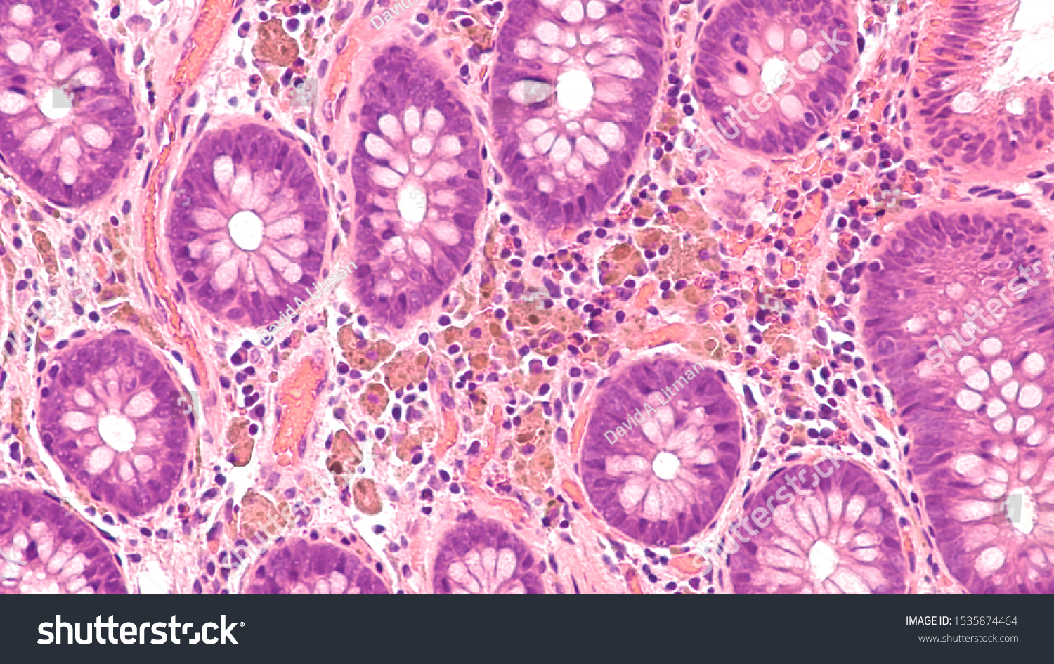 Photomicrograph Endoscopic Colon Biopsy Colonoscopy Showing Stock Photo