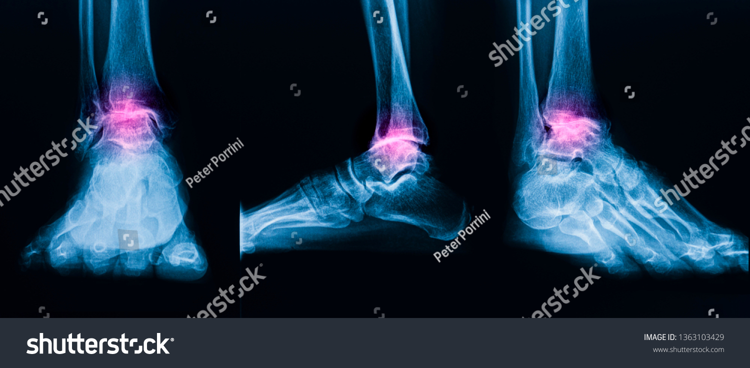 Plain Radiograph Human Ankle Anteroposterior Lateral Stock Photo