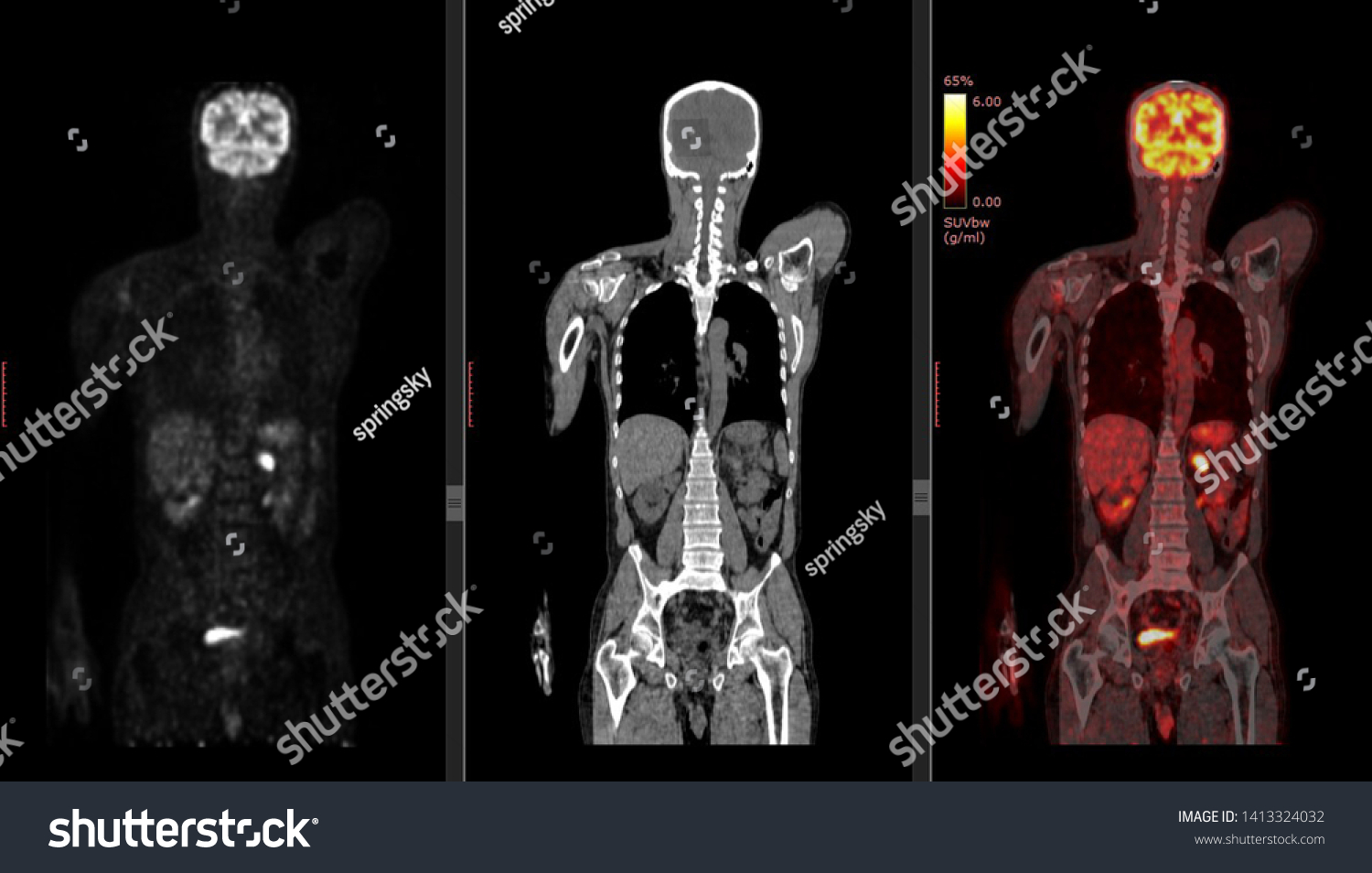 Positron Emission Tomography Pet Ct ScanẢnh có sẵn1413324032 Shutterstock