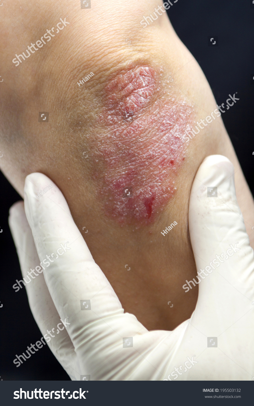 Psoriasis On Elbow Closeup Stock Photo 195503132 Shutterstock