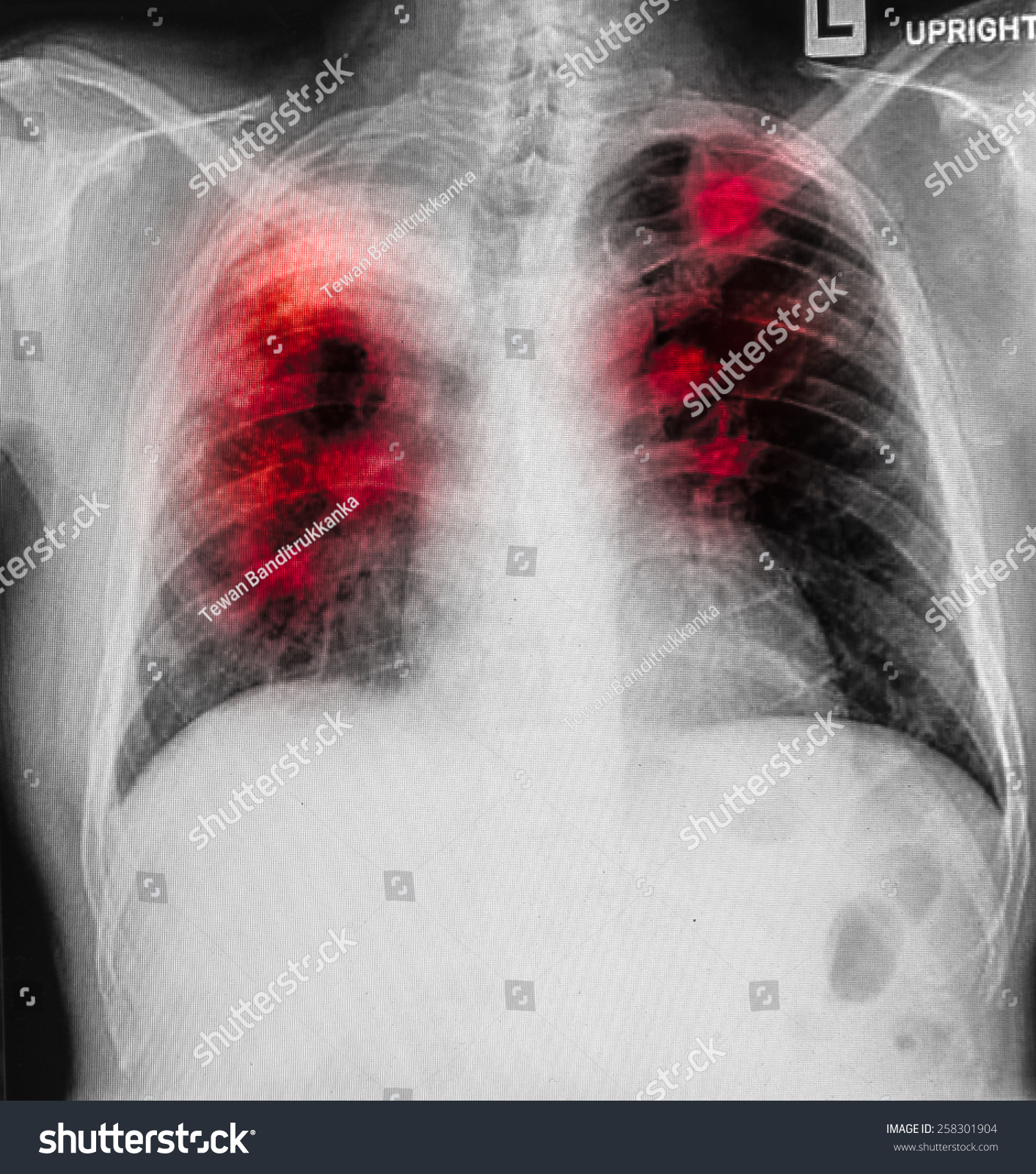 Pulmonary Tuberculosis Chest Xray Right Lung Stock Photo 258301904 