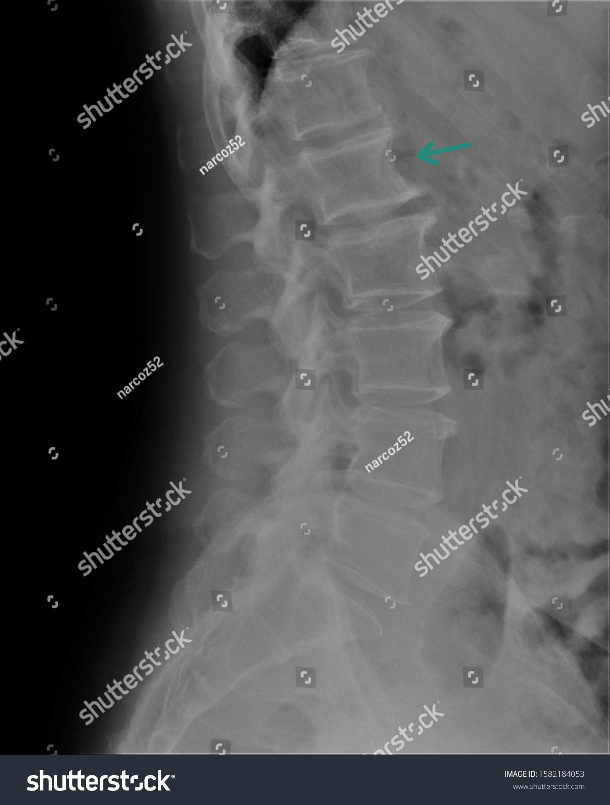 Radiograph Lumbar Sacral Spine Lateral Projection Foto De Stock