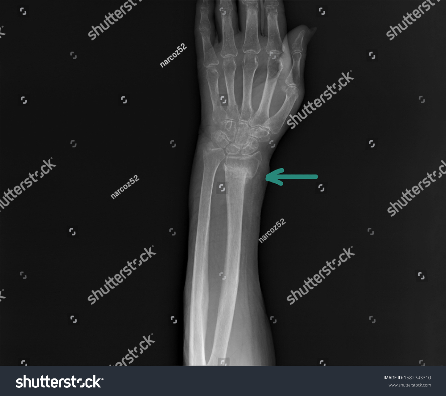 Radiography Forearm Wrist Bones Fracture Distal Stock Photo Edit Now