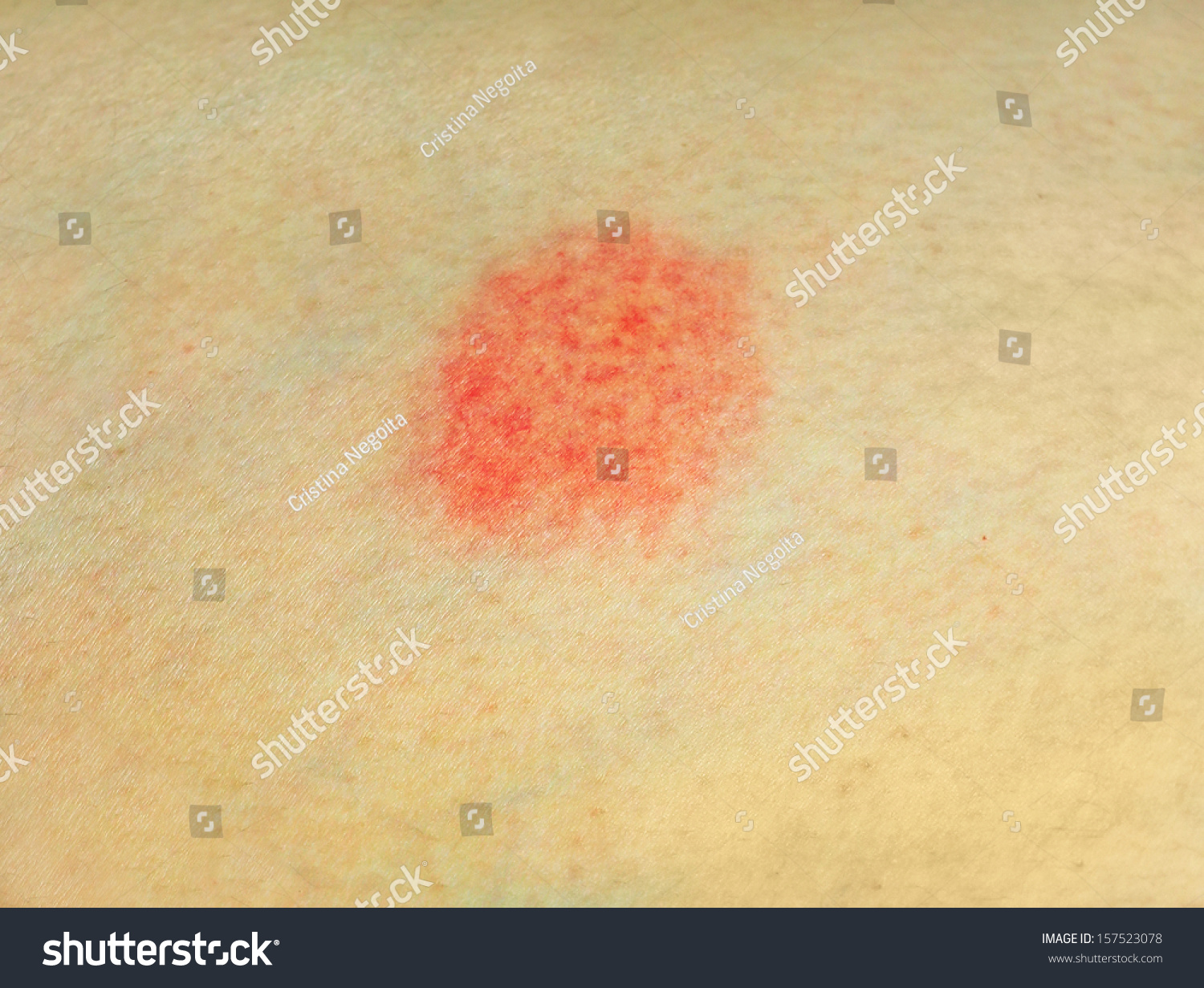 red-spot-on-skin-stock-photo-157523078-shutterstock