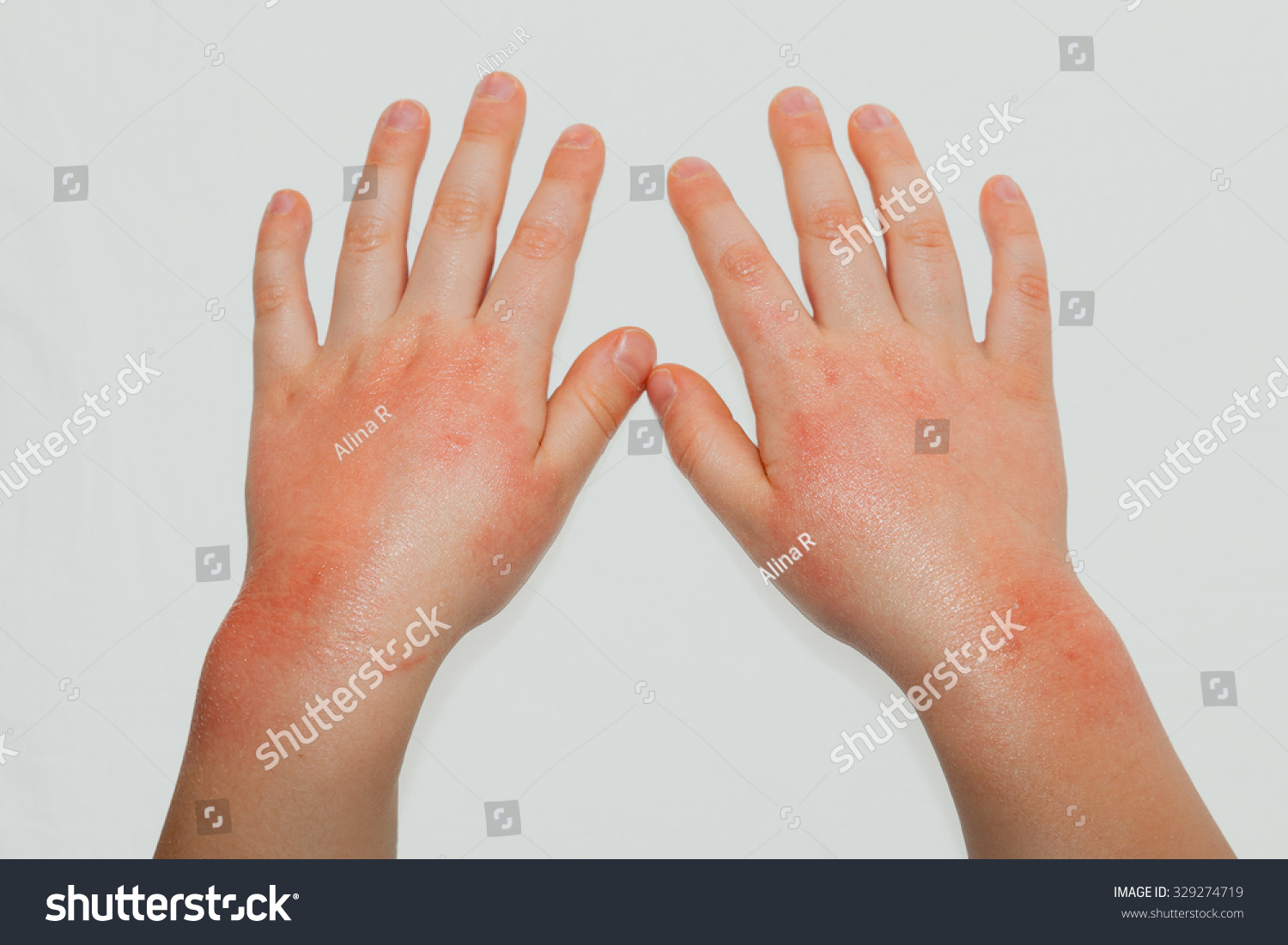 Red Spots Scratches On Child Hands Stock Photo 329274719