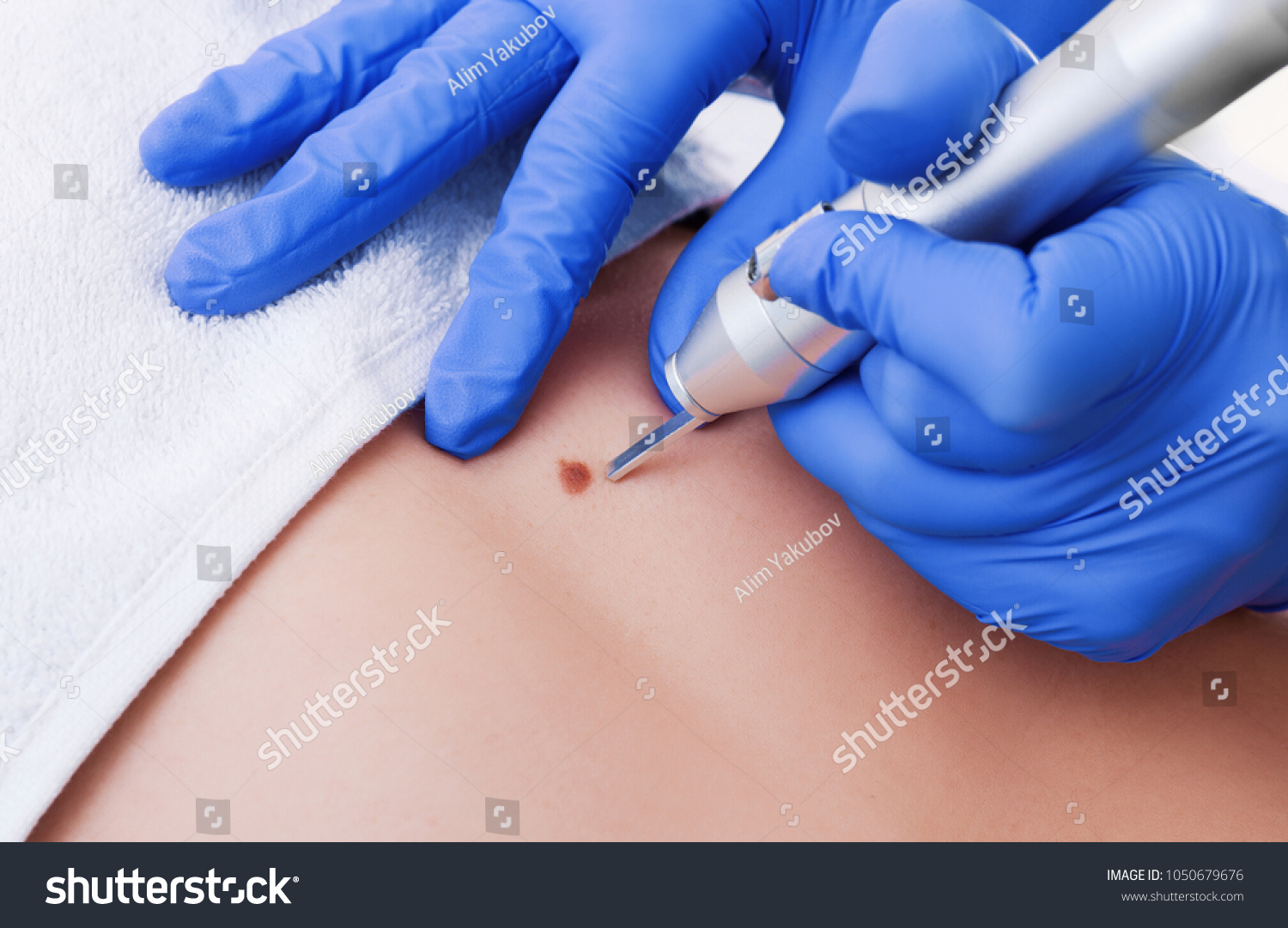 1 358 Pigmented Skin Lesion Images Stock Photos Vectors Shutterstock