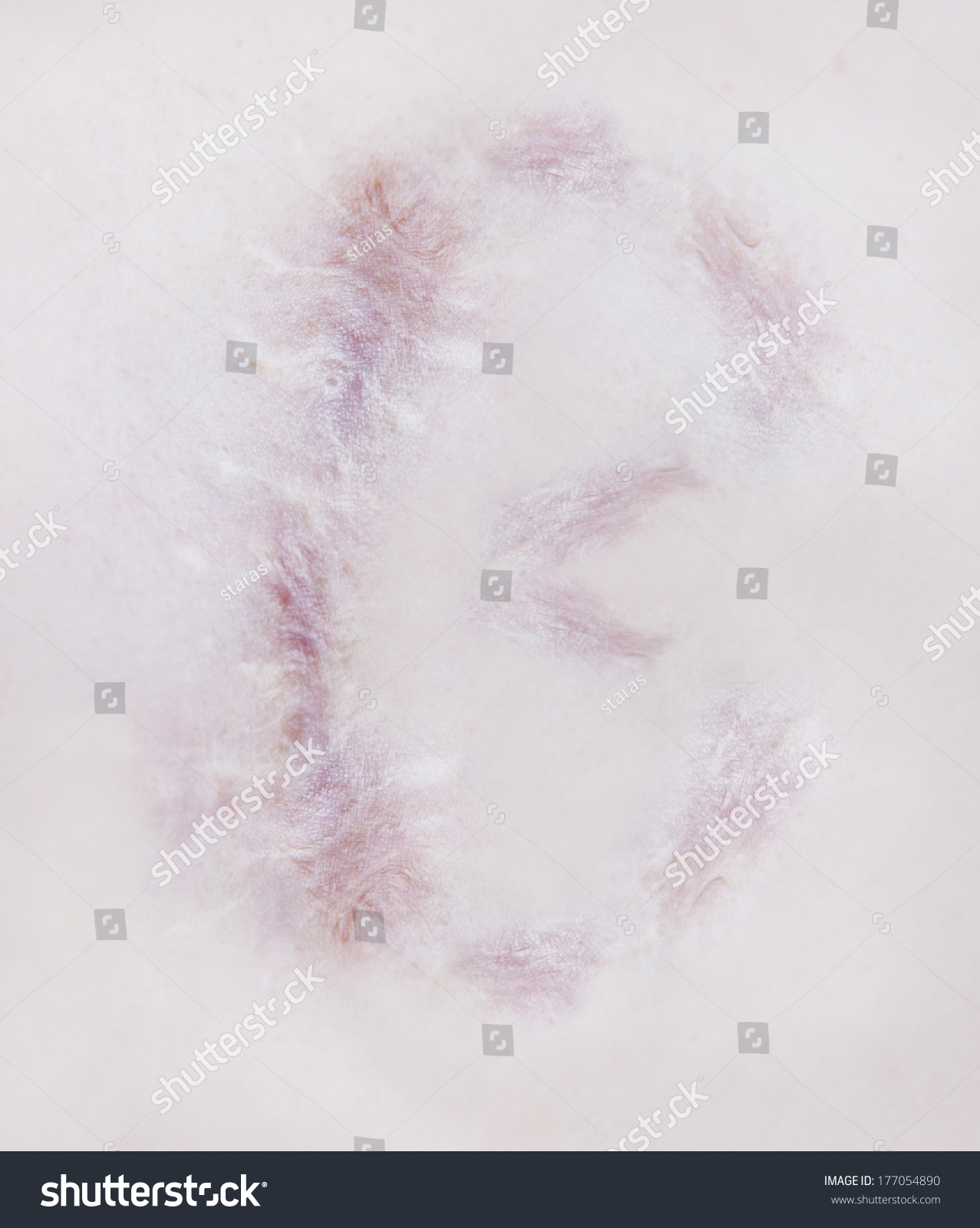 scar on human skin stock photo 121658896 scar letter b on human skin stock photo 177054890 scar on human skin stock photo 121658896 scar letter b on human skin stock photo 177054890