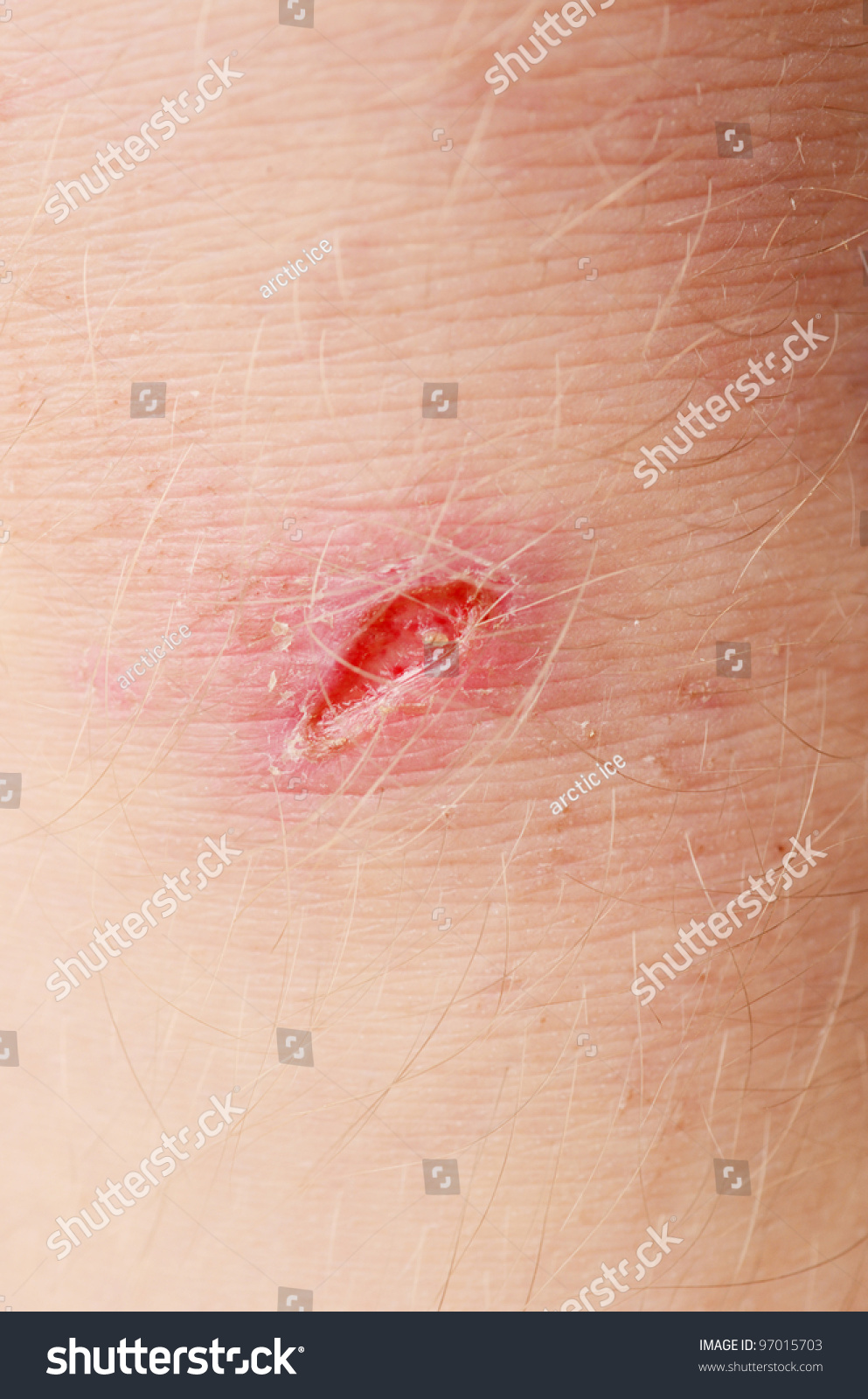 scar on human skin stock photo 121658896 scar on human skin stock photo 97015703 scar on human skin stock photo 121658896 scar on human skin stock photo 97015703
