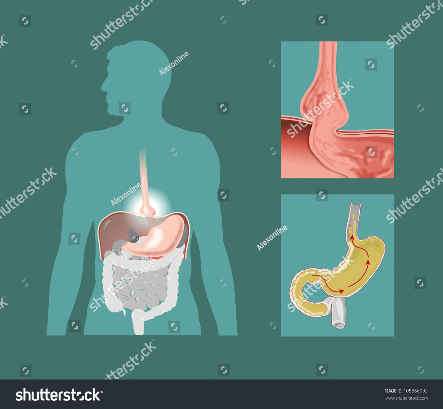 Schematic Drawing Hiatal Hernia Stock Illustration Shutterstock