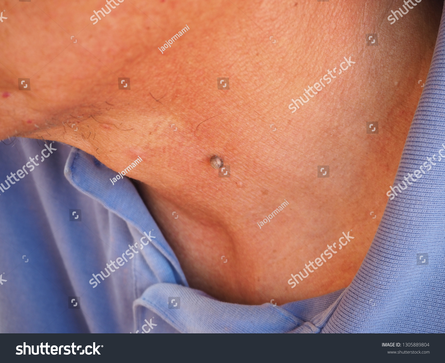 Seborrheic Keratoses Verruca Senilis On Skin Foto Stok 1305889804