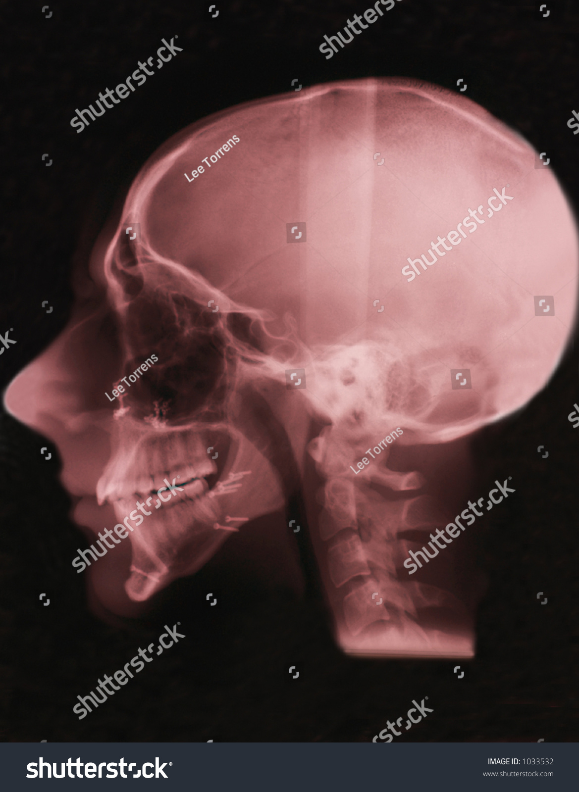 Side View Head XRay Showing Screws Used To Reconstruct The Jaw Bones