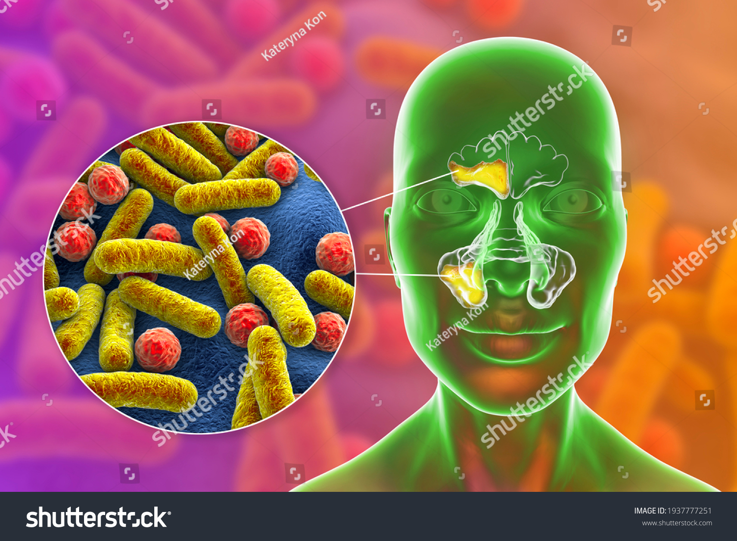 Sinusitis Inflammation Paranasal Cavities 3d Illustration Stock