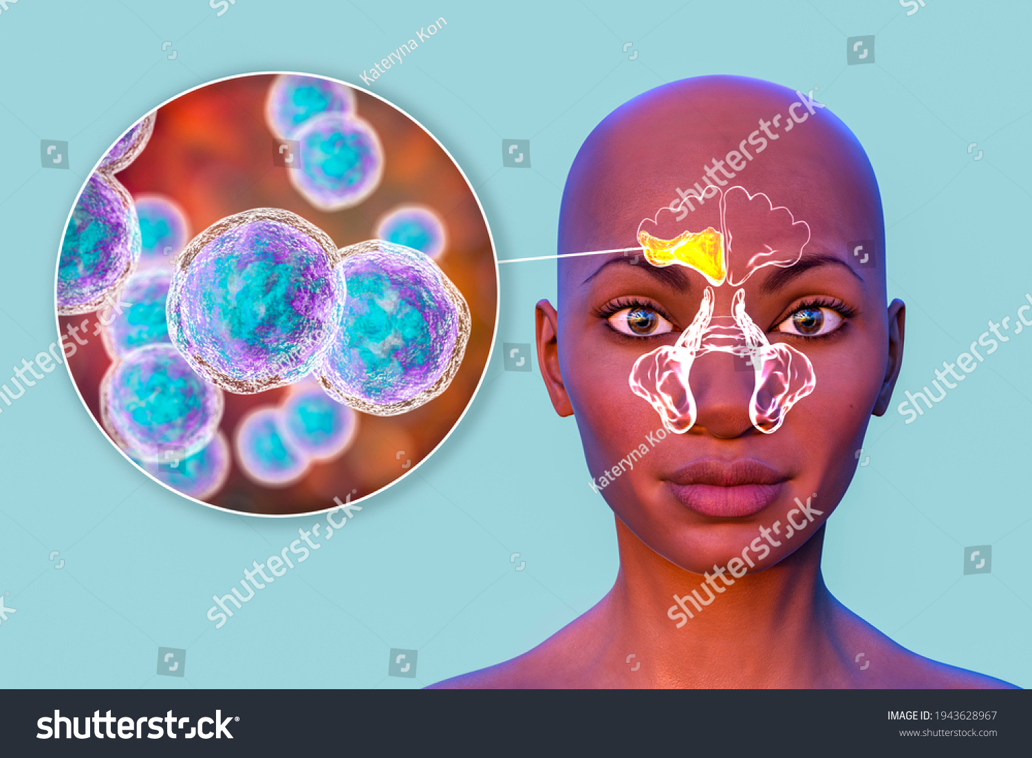 Sinusitis Inflammation Paranasal Cavities 3d Illustration Stock