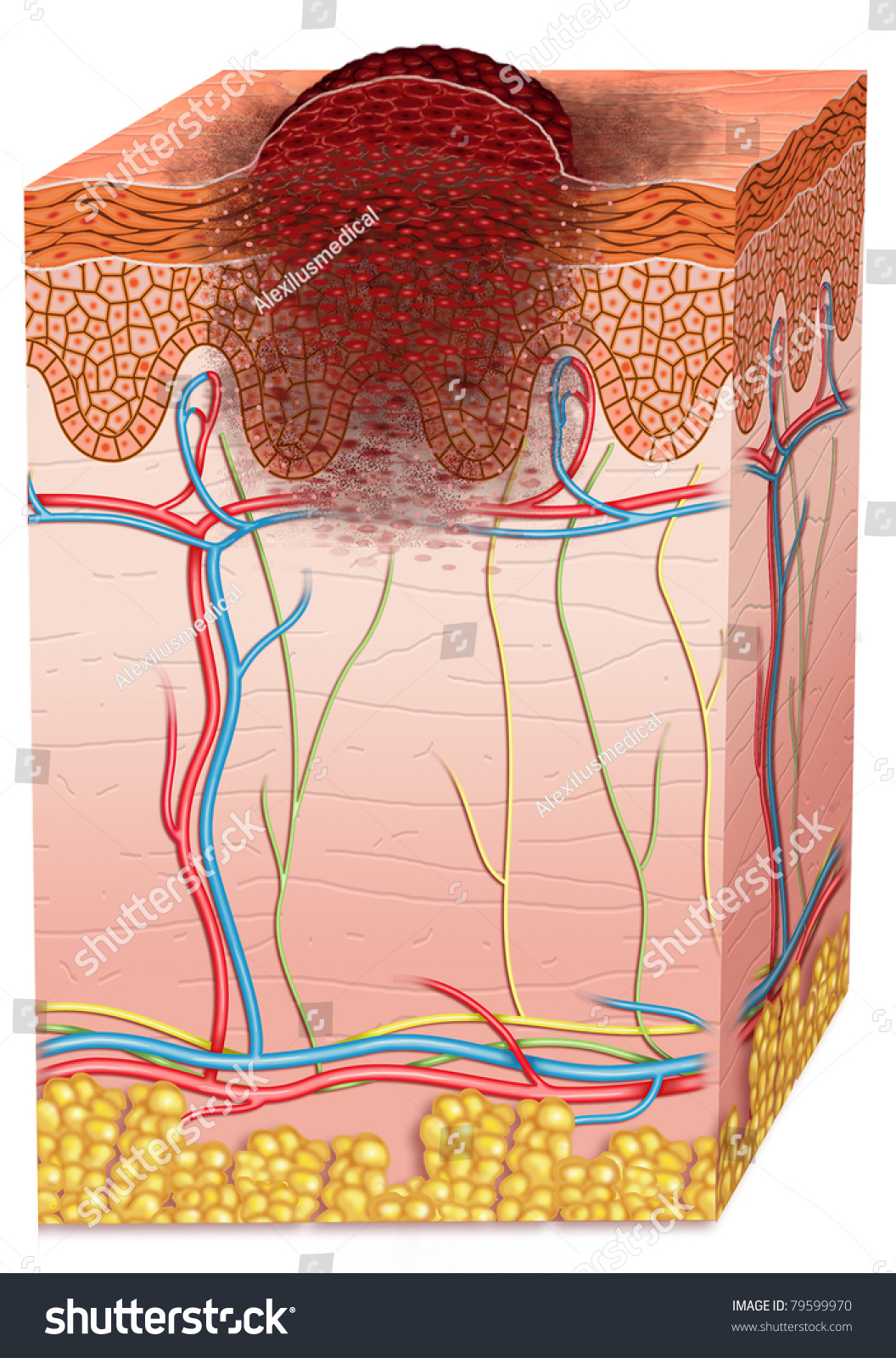 Skin Cancer Stock Photo 79599970 : Shutterstock