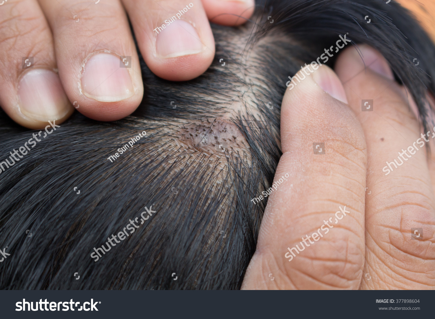 skin-disease-on-the-head-stock-photo-377898604-shutterstock