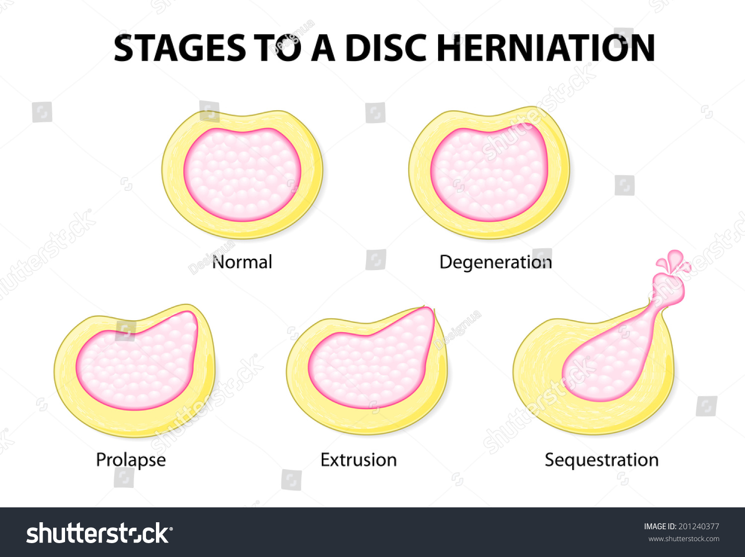 Stages Disc Herniation Normal Degeneration Prolapse Stock Illustration