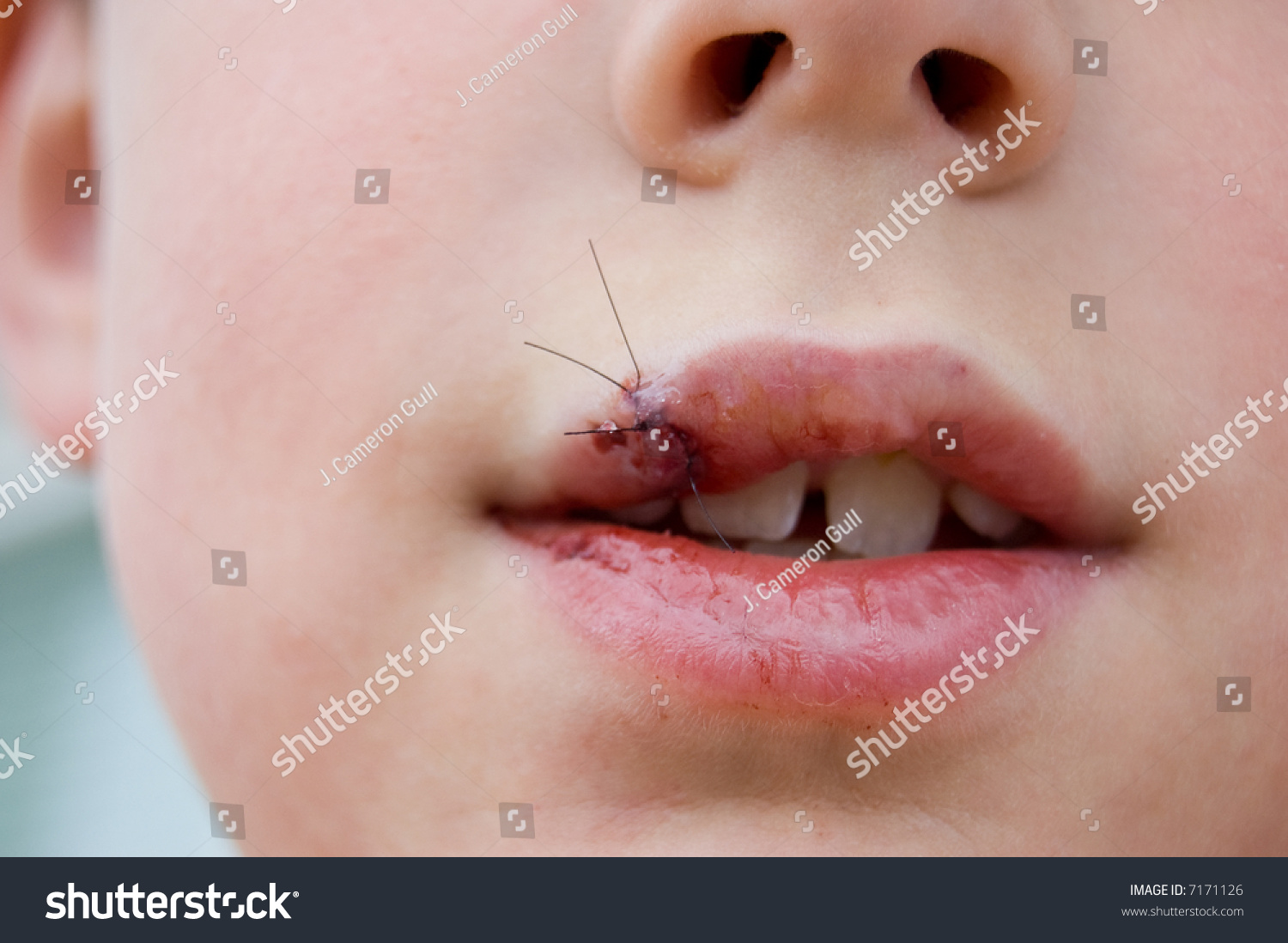 stitches-in-fat-lip-stock-photo-7171126-shutterstock