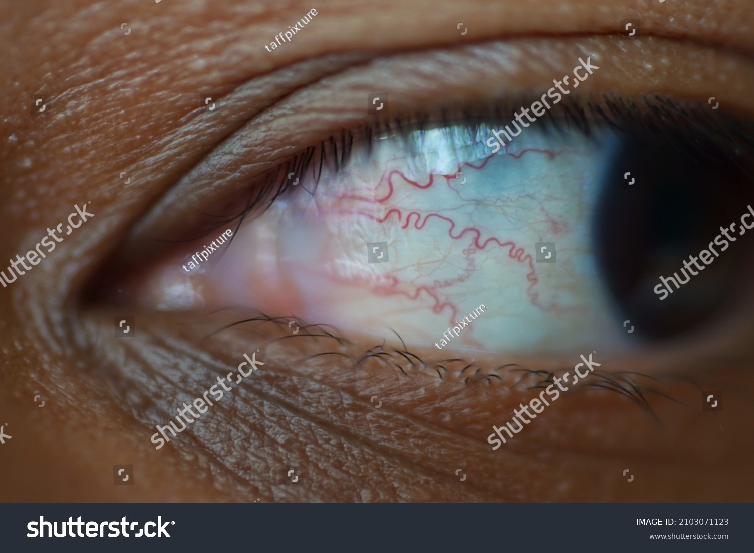 Subconjunctival Hemorrhage Red Lines Spots On Stock Photo Edit Now