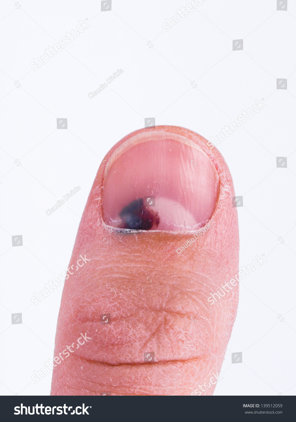 toenail condition