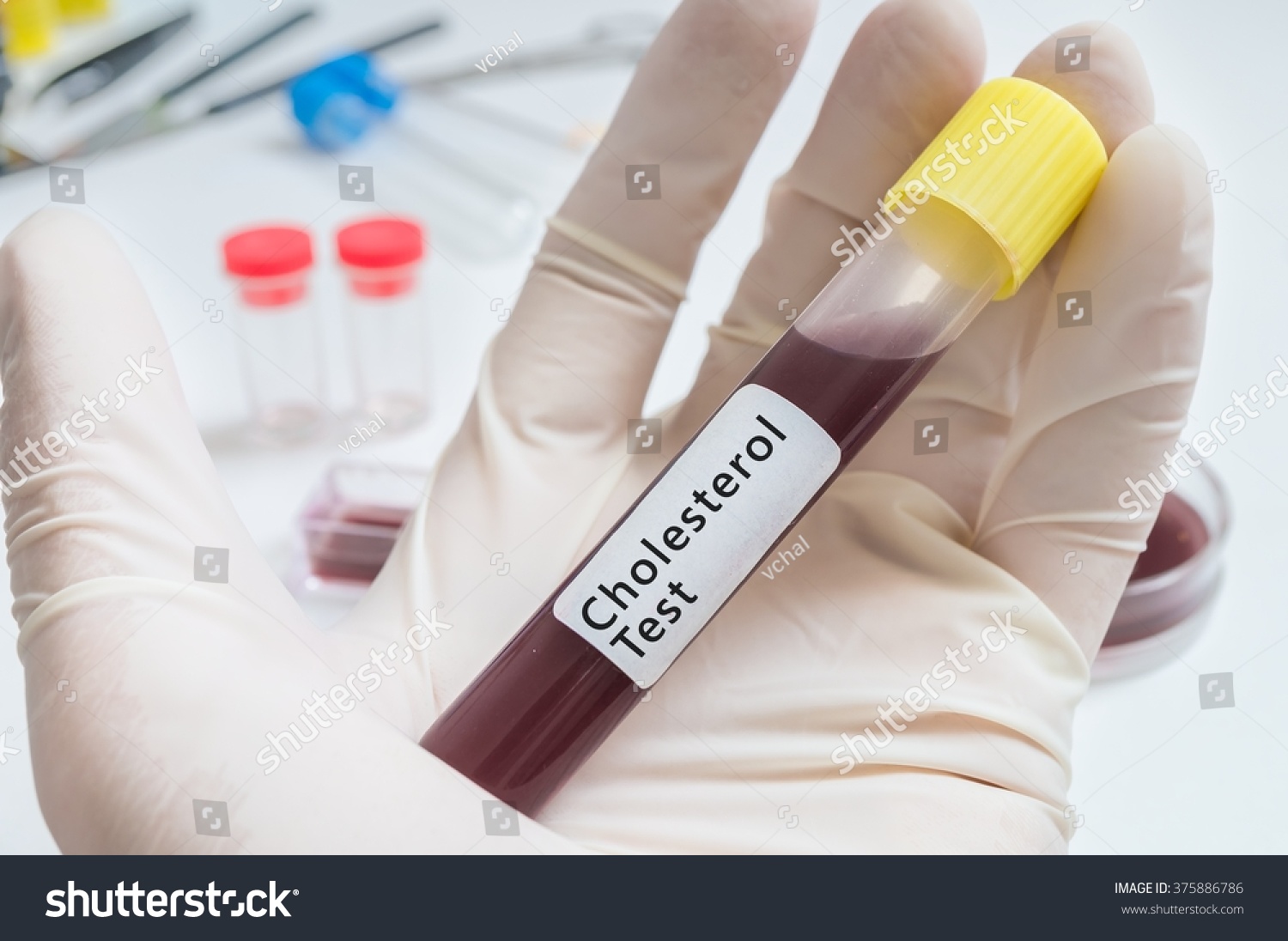 Test Tube For Cholesterol Test In Hand. Stock Photo 375886786