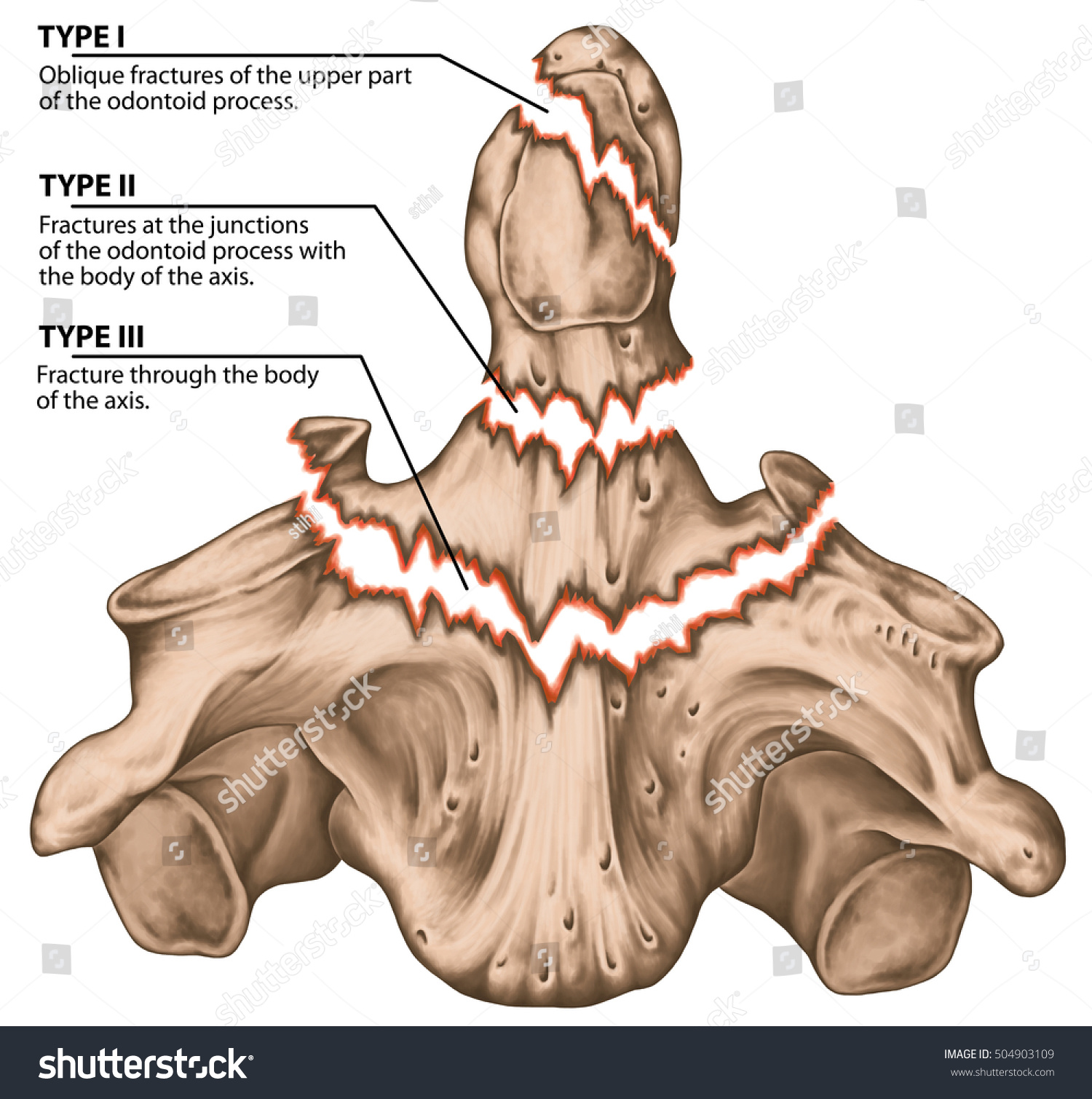 Three Types Odontoid Fractures Fractures Axis Stock Illustration