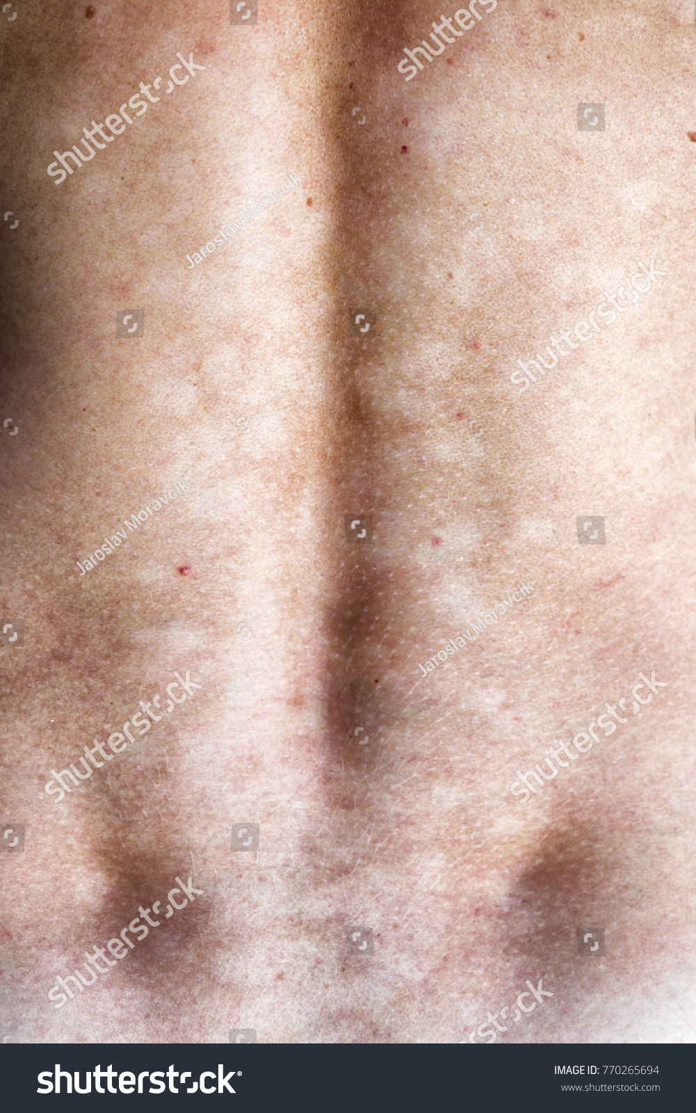 Tinea Versicolor Pityriasis Versicolor Fungal Infection 库存照片立即编辑770265694