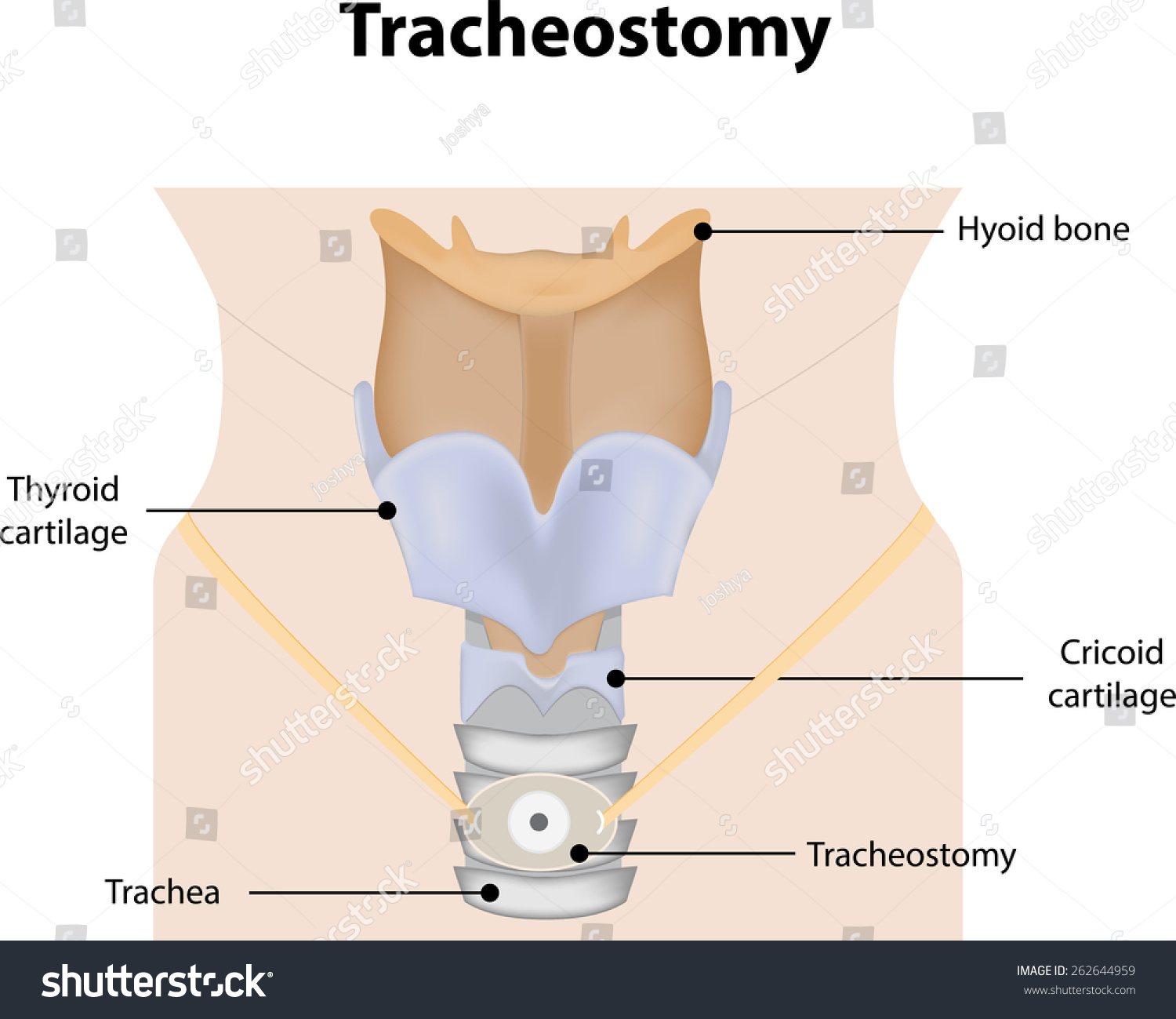 Tracheostomy Labeled Diagram Stock Illustration 262644959