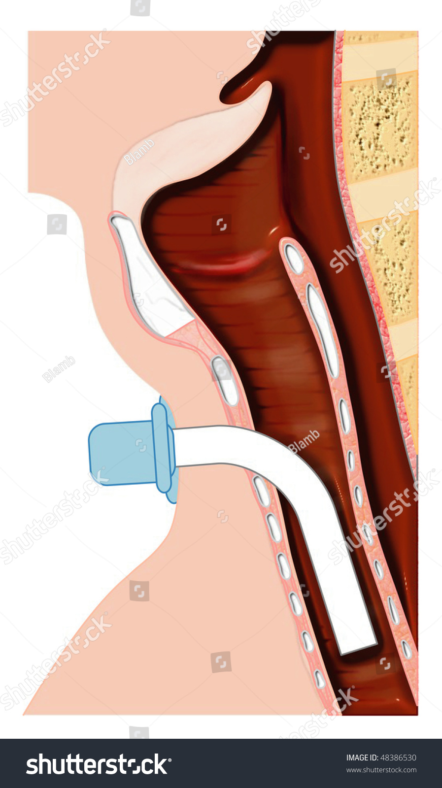 Tracheotomy Tube Placement Stock Illustration Shutterstock