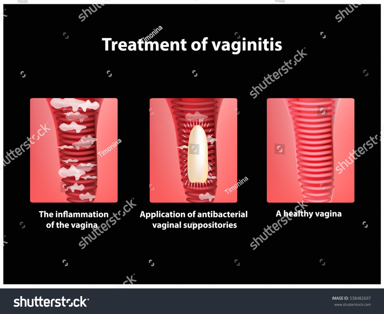 Treatment Vaginitis Suppositories Inflammation Vagina Infographics