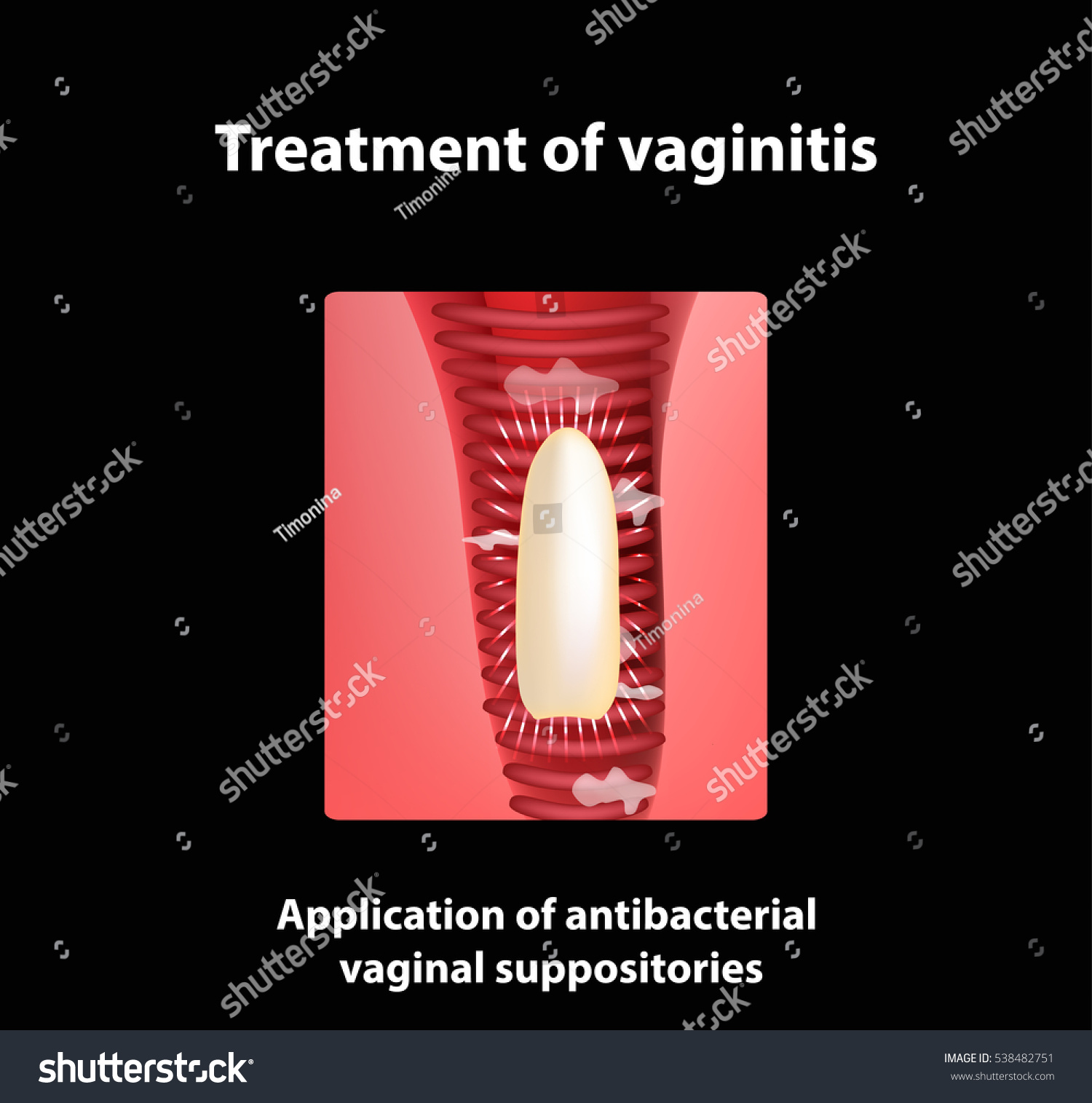 Treatment Vaginitis Suppositories Inflammation Vagina Infographics