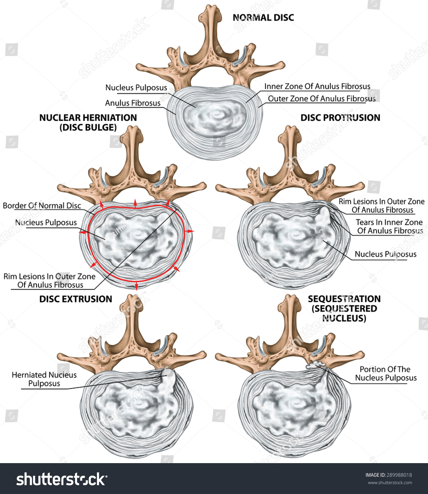 Types Stages Lumbar Disc Herniation Herniated Stock Illustration ...